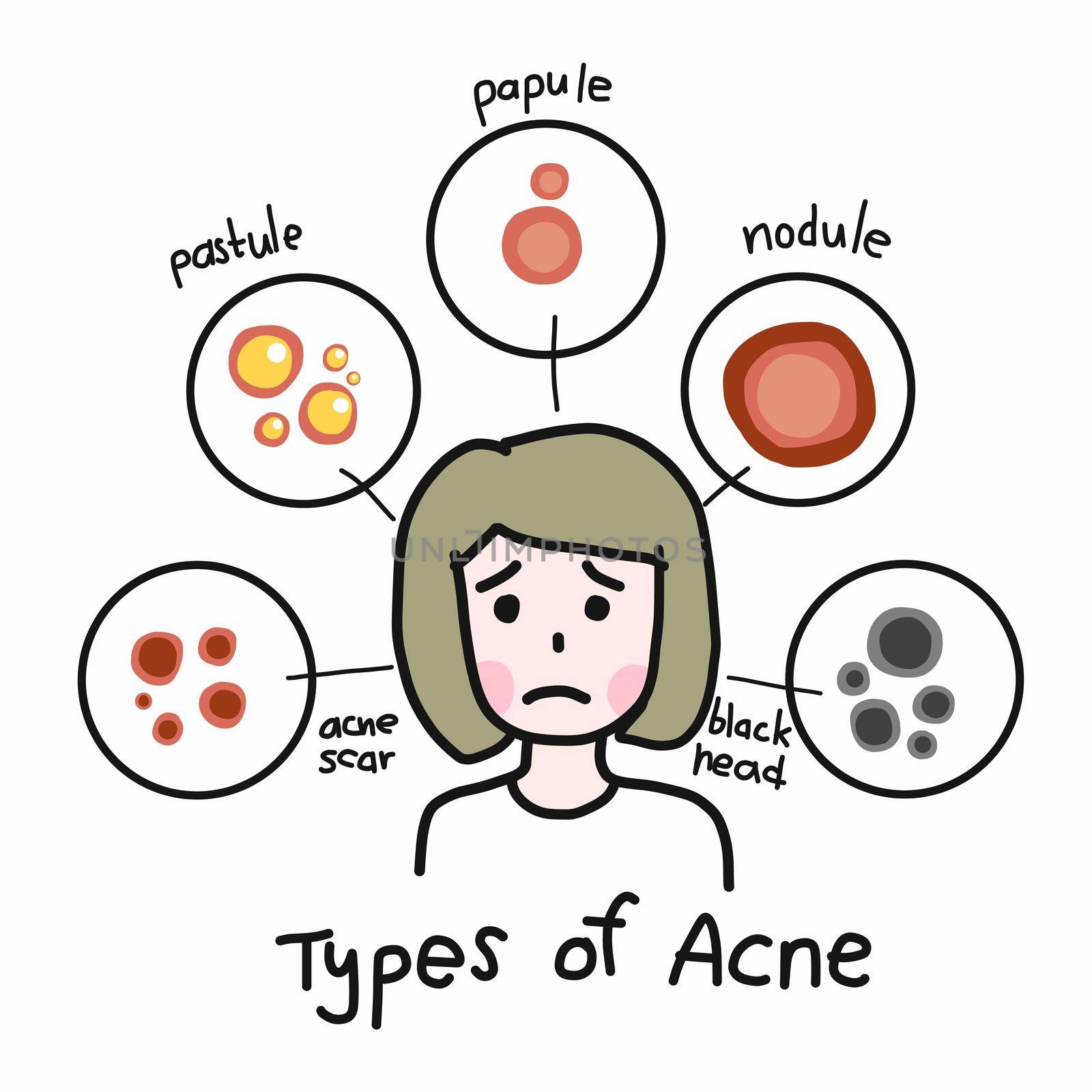 Type of acne , Cute woman cartoon face vector illustration