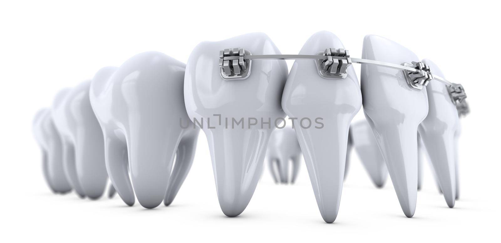 Metal dental brackets mounted on the teeth. 3d render.
