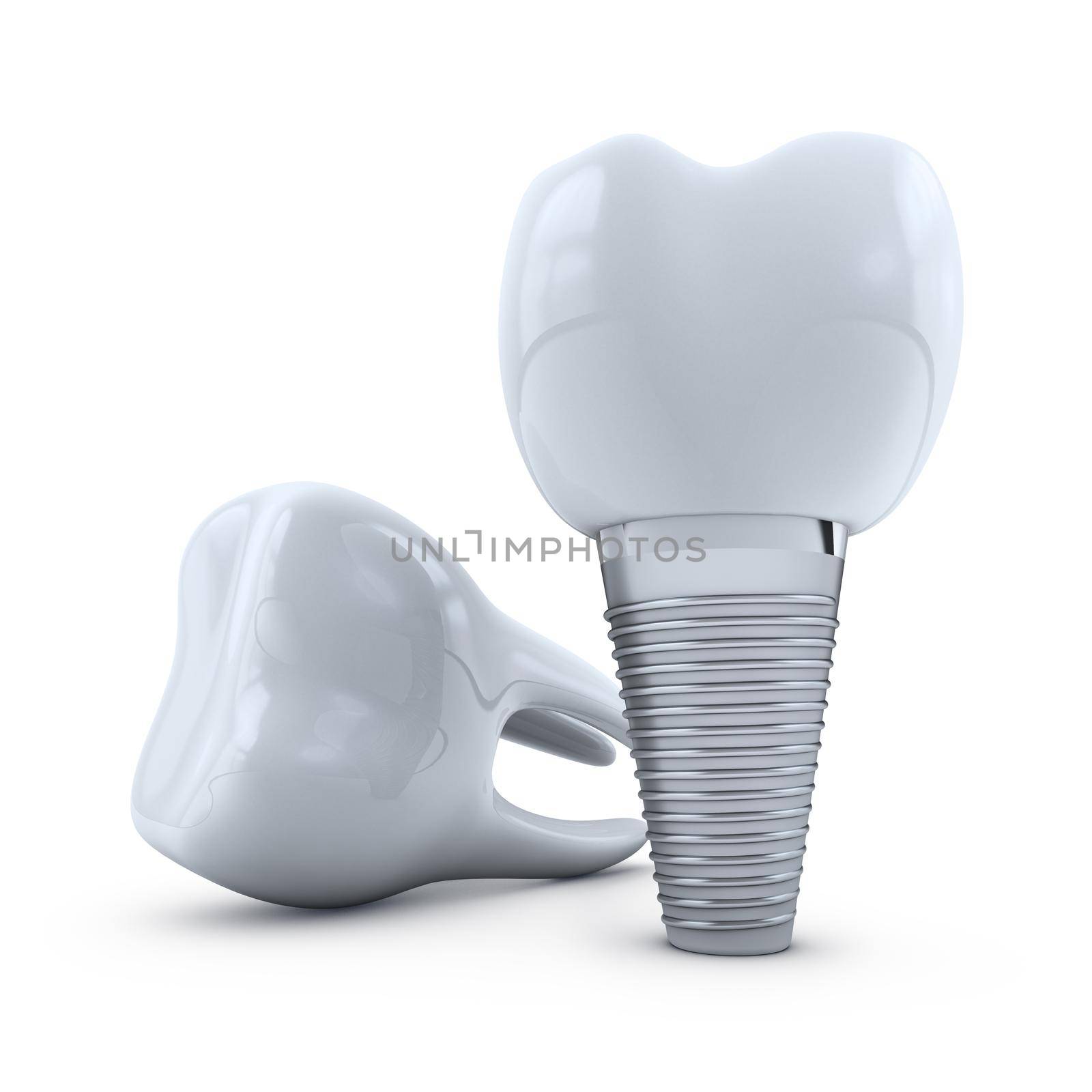 tooth implant and  molar on white background. 3d render.