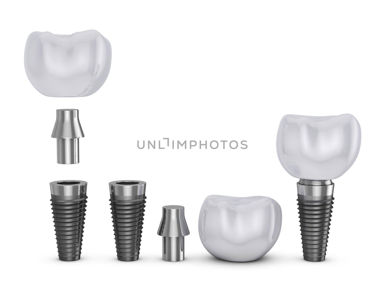Tooth implant in disassembled form. 3d rendering.