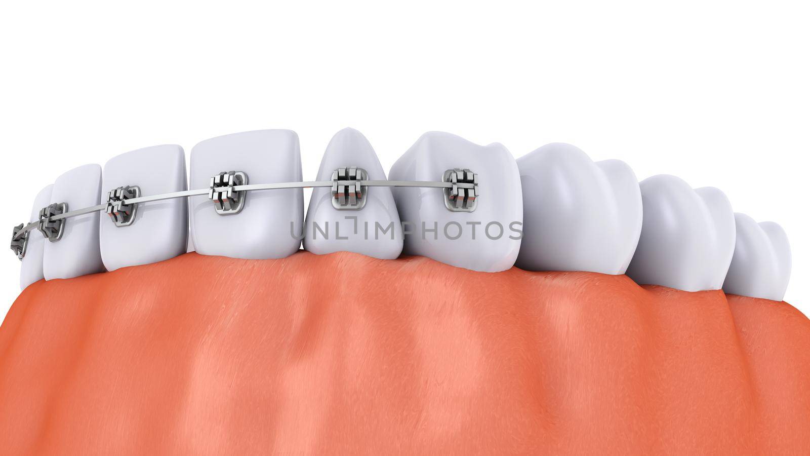 a teeth with braces and dental implants, 3d render