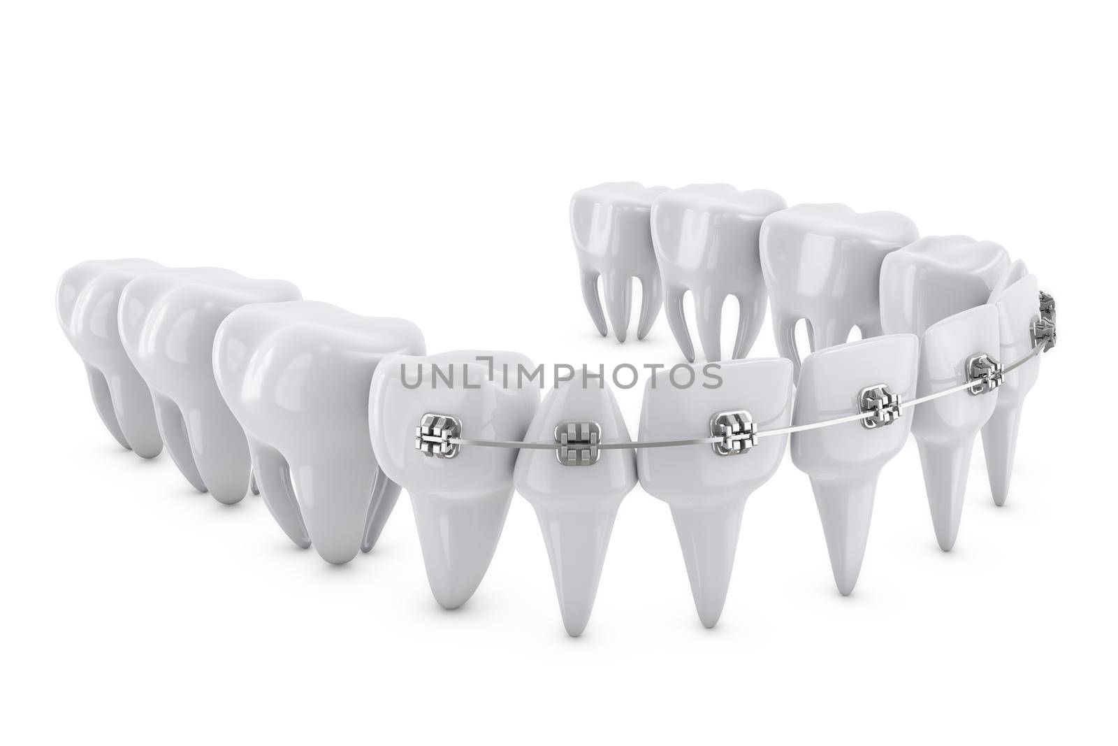 metal dental brackets mounted on the teeth