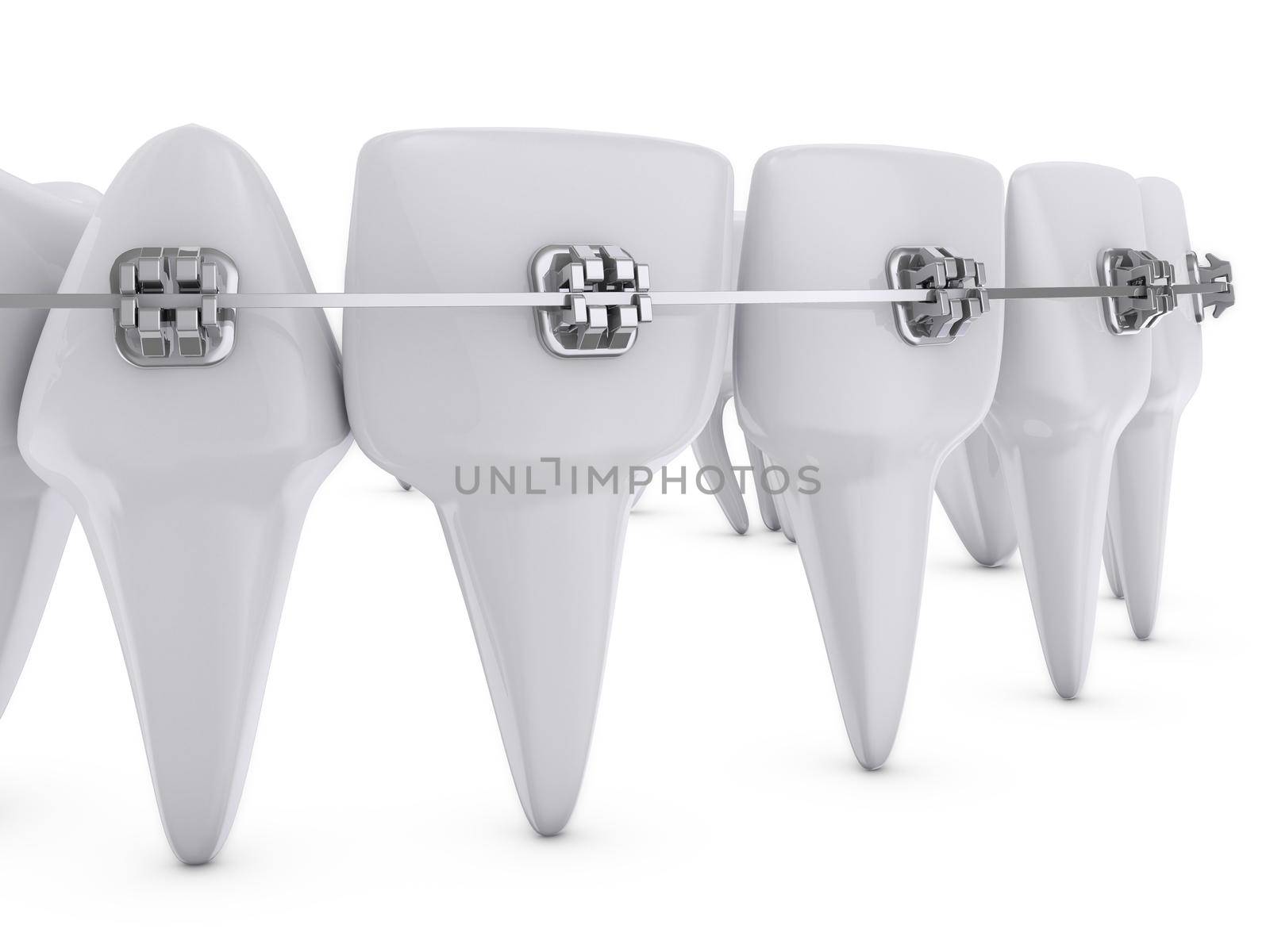 dental brackets by rommma