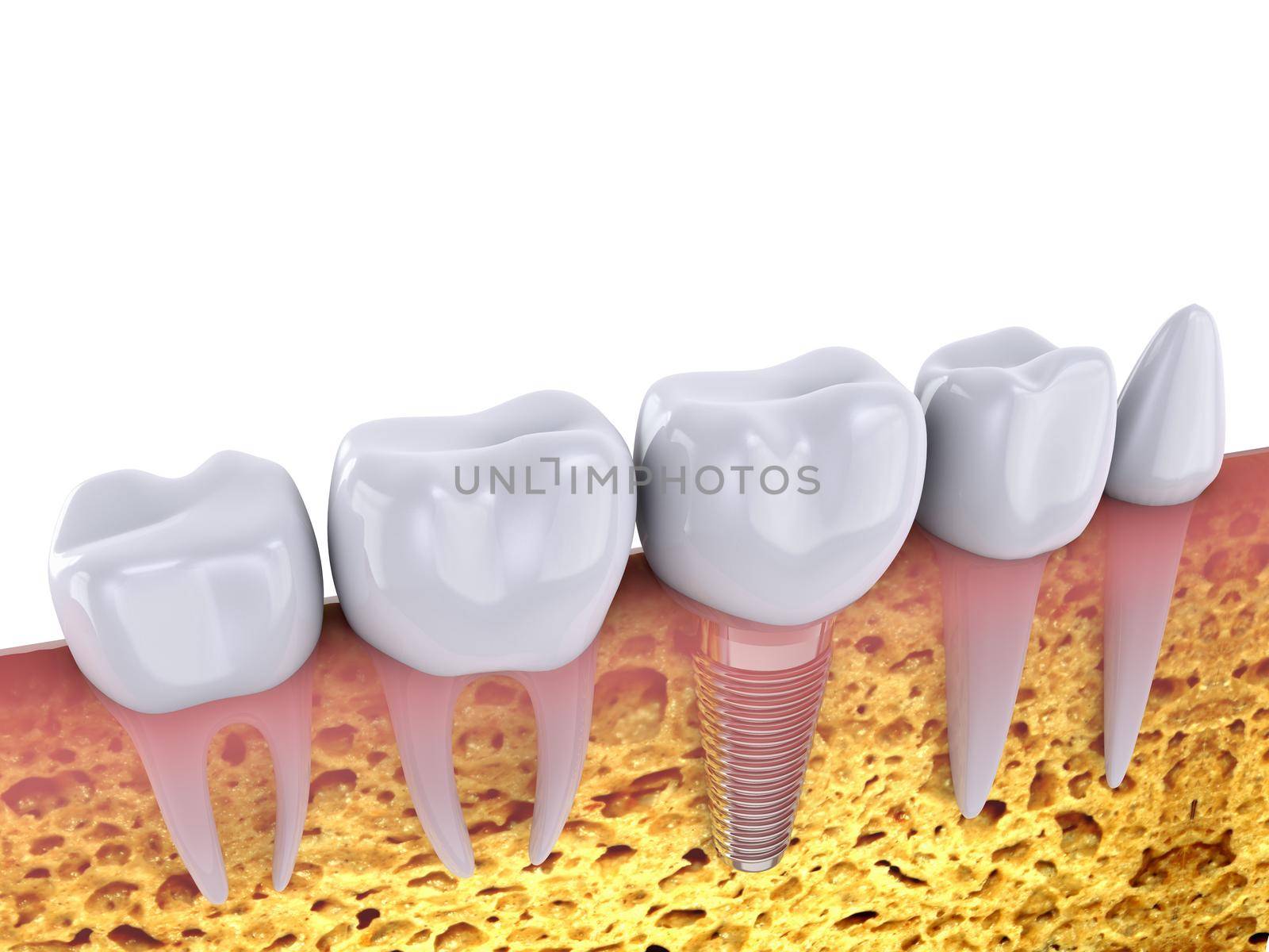 molars and implant in the jaw bone, 3d render