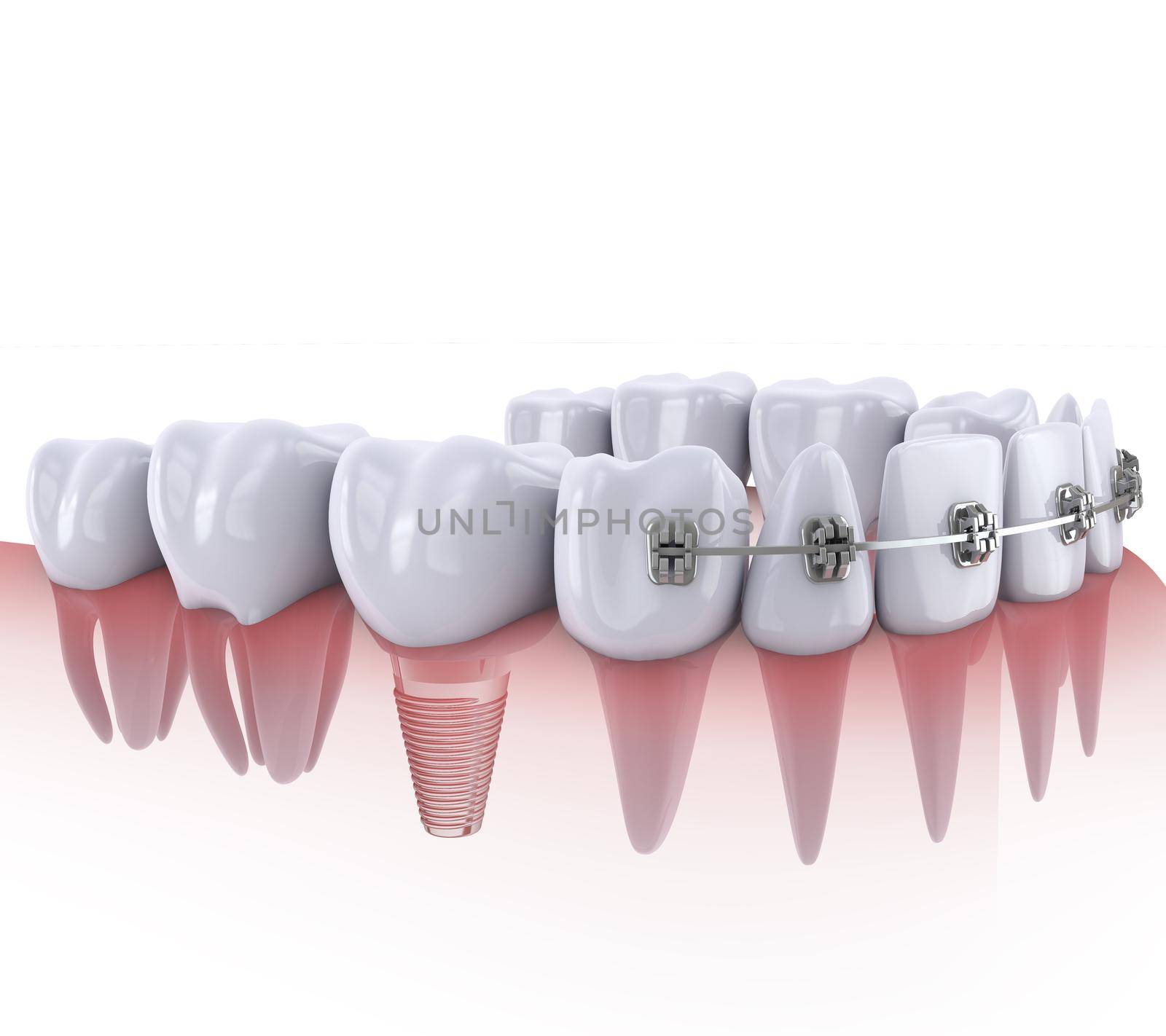 a teeth with braces and dental implants
