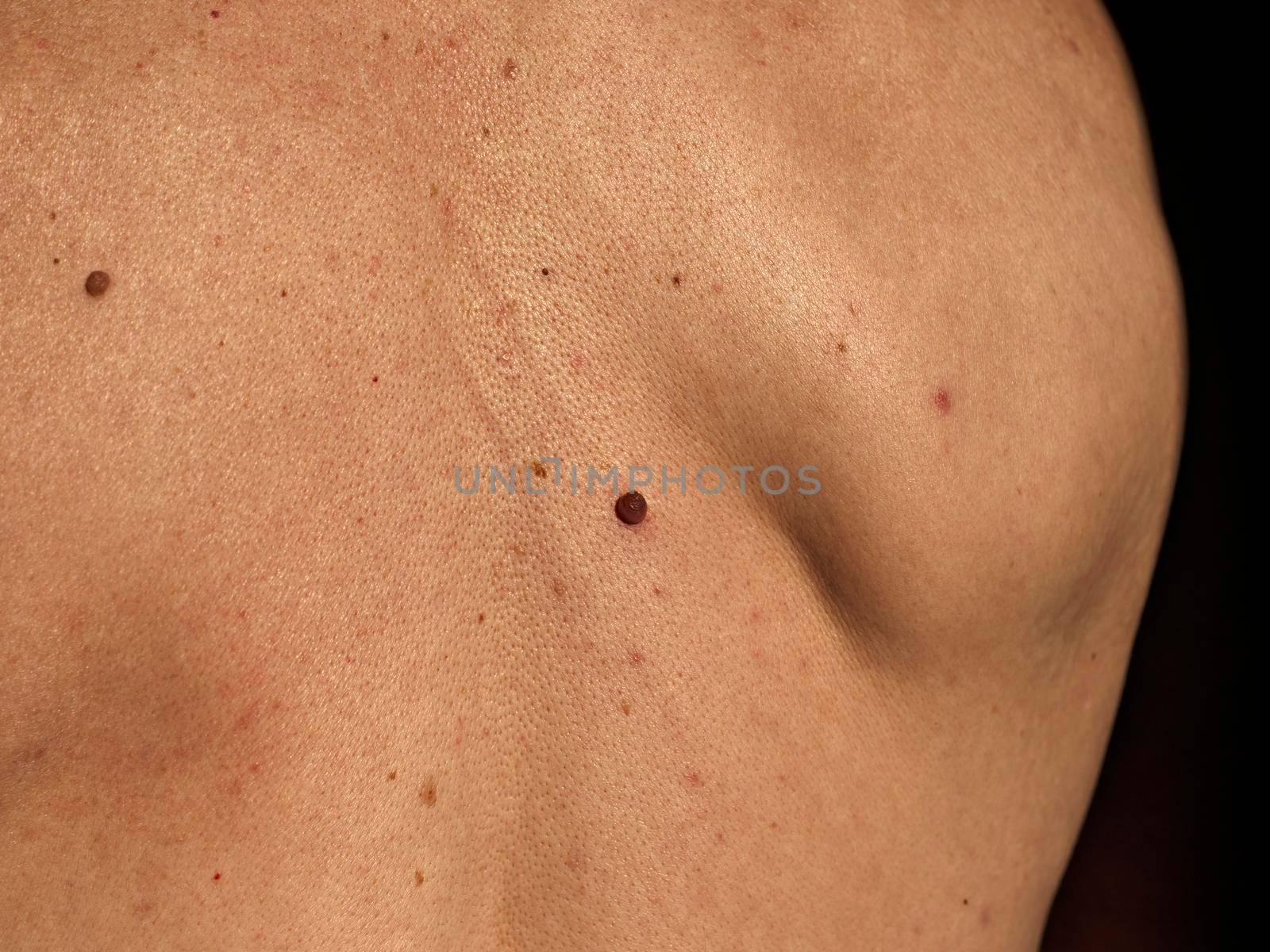 Growing red mole on man's back. Skin cancer symptom.