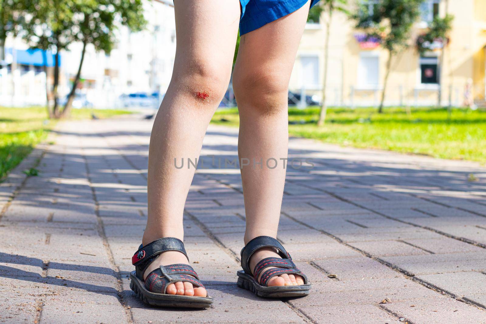 The wound on the child's leg . Fell on the road. Broken knee. Health. Article about the fall of a child. Article about the treatment of wounds. Bad leg . The child fell and broke his knee . blood