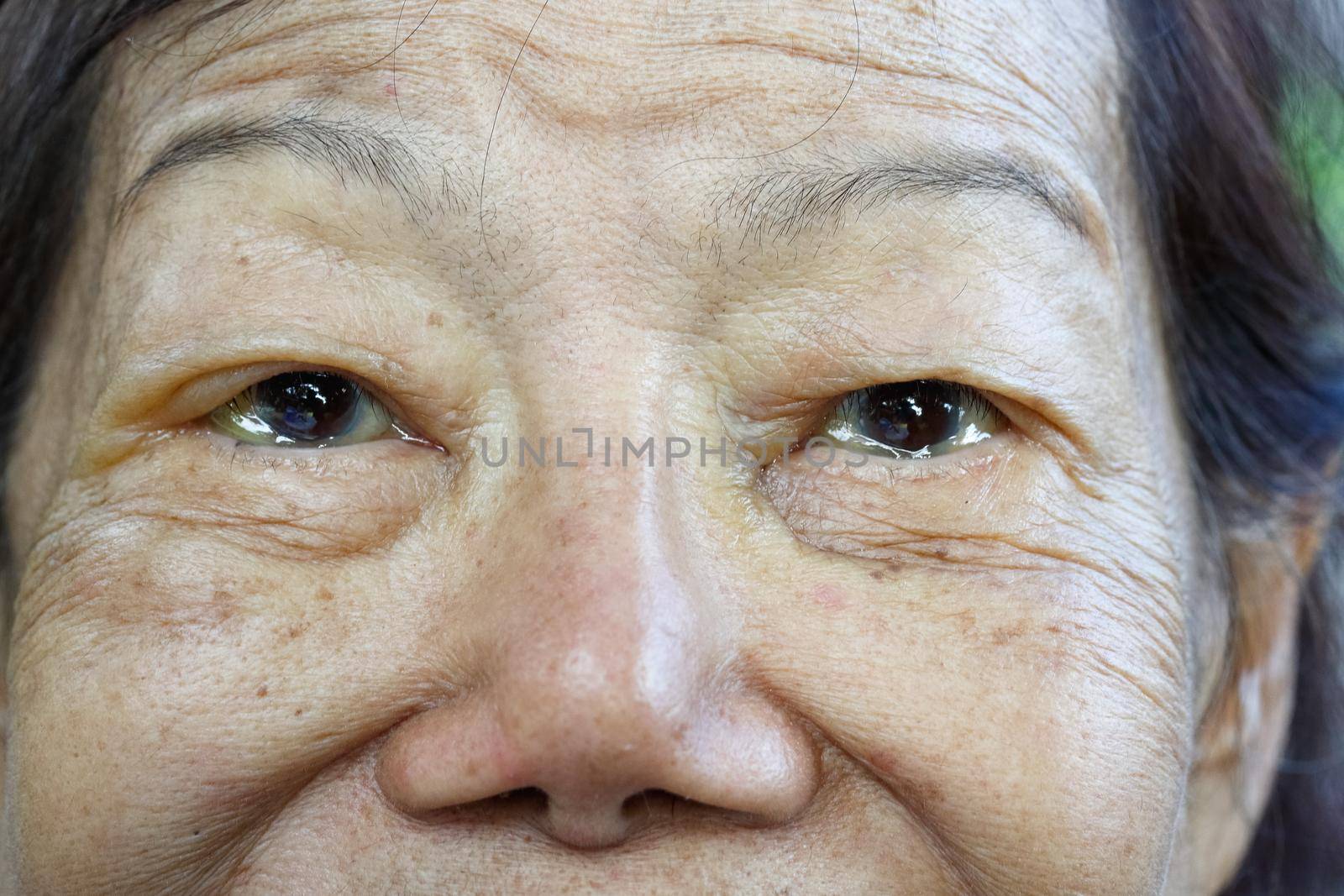 eye edema in elderly woman