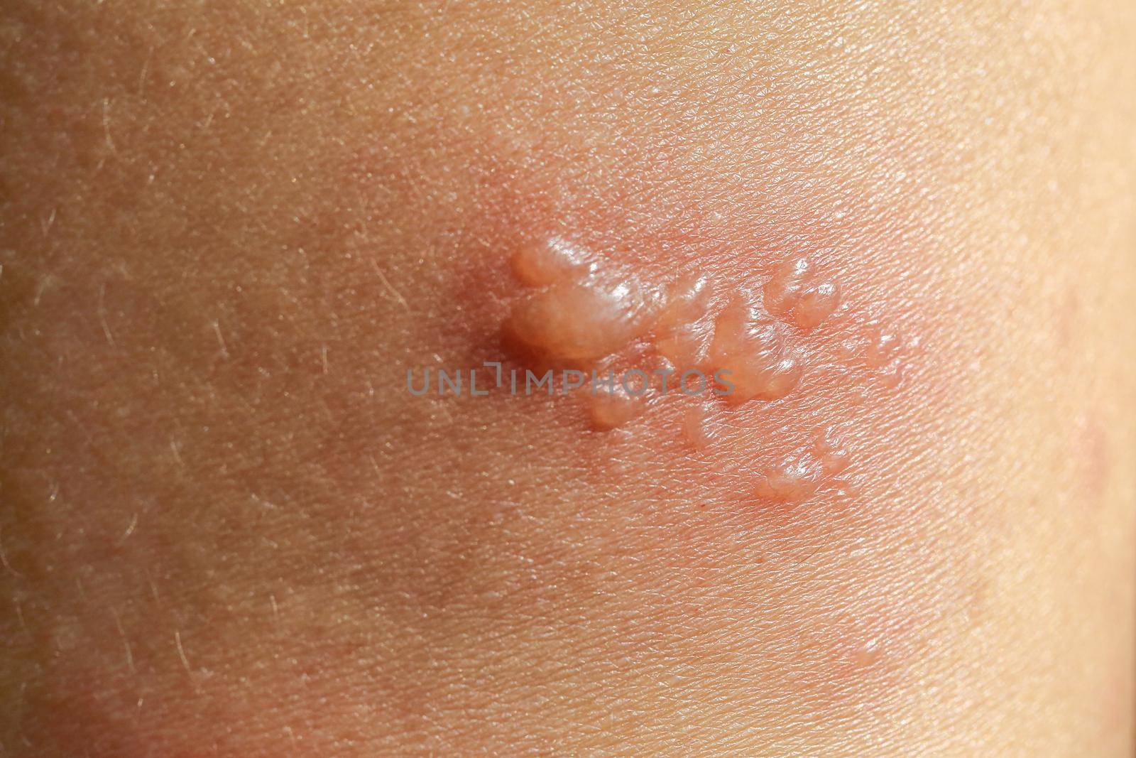 skin rash as allergic symptoms due to arm fiberglass cast by toa55