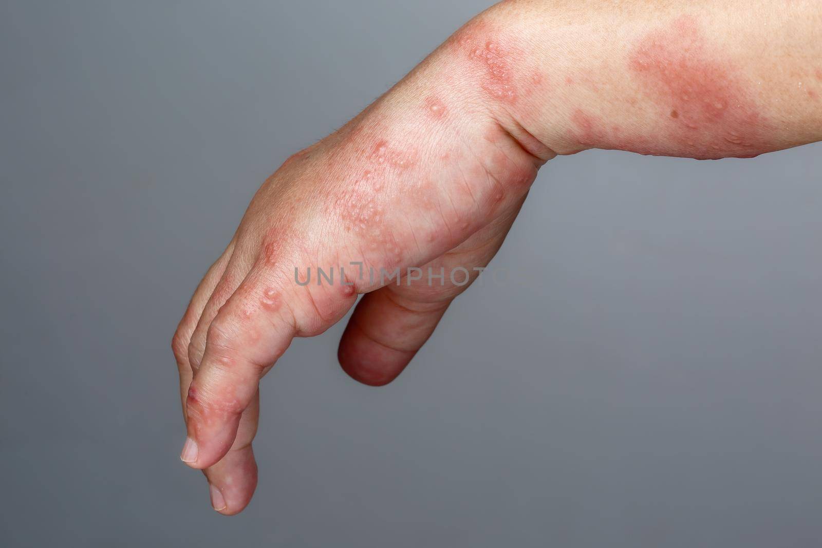 Shingles, Zoster or Herpes Zoster symptoms on arm by toa55