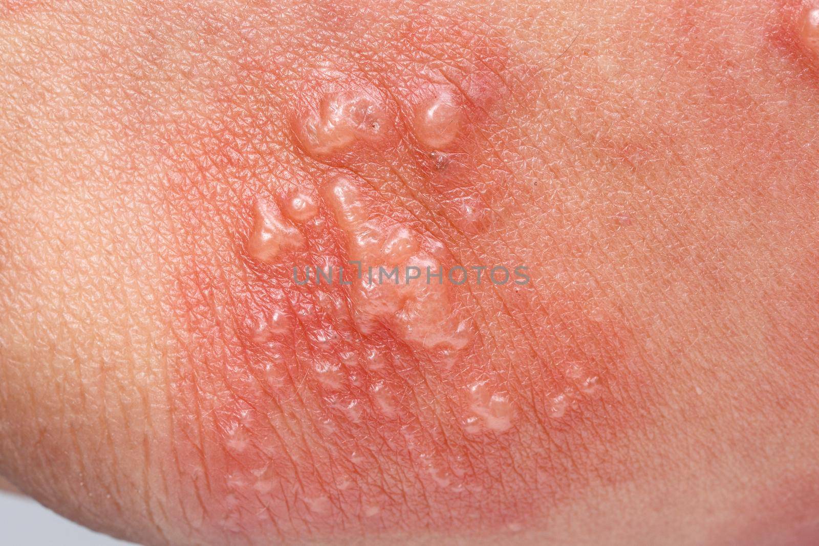 Shingles, Zoster or Herpes Zoster symptoms on arm