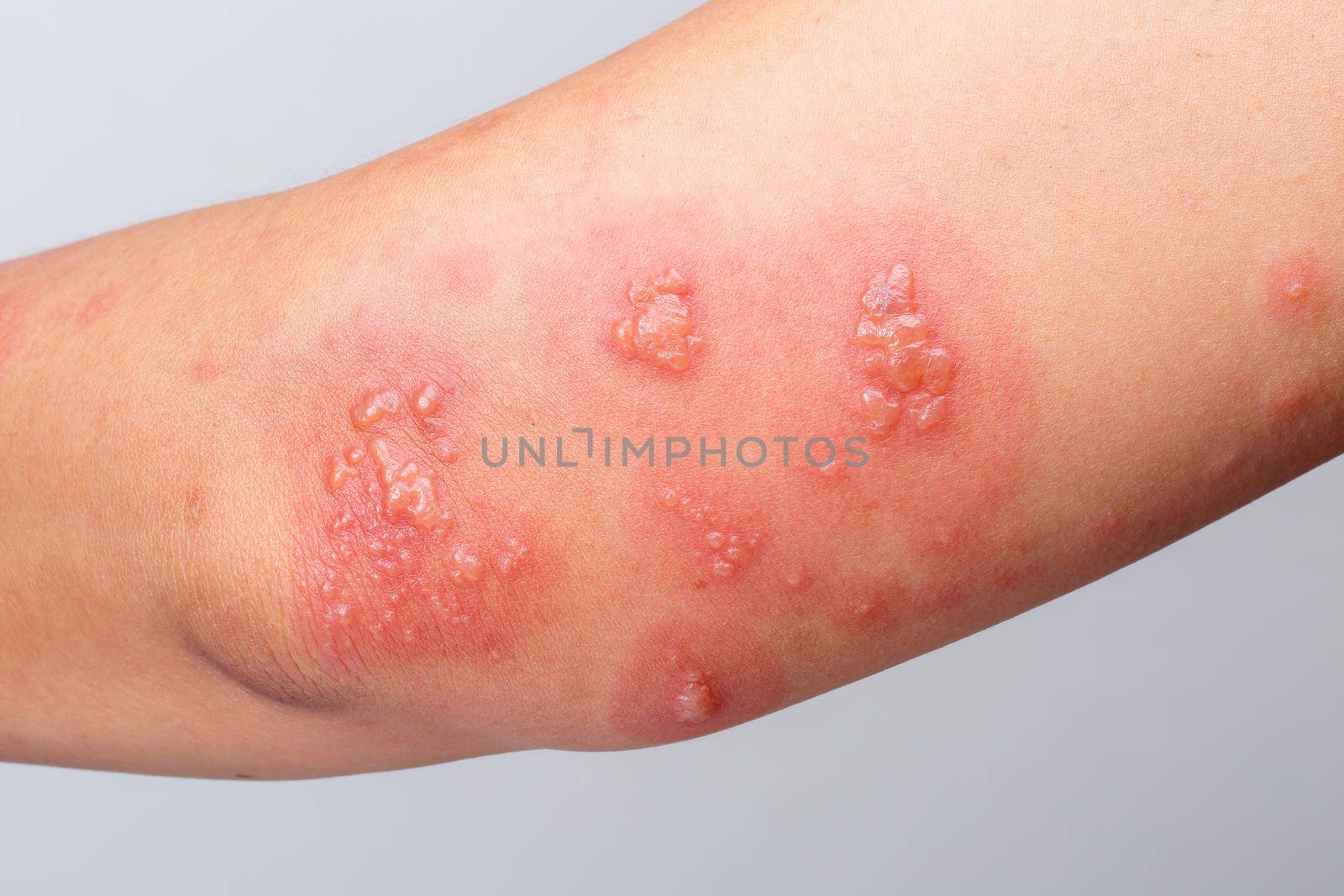 Shingles, Zoster or Herpes Zoster symptoms on arm