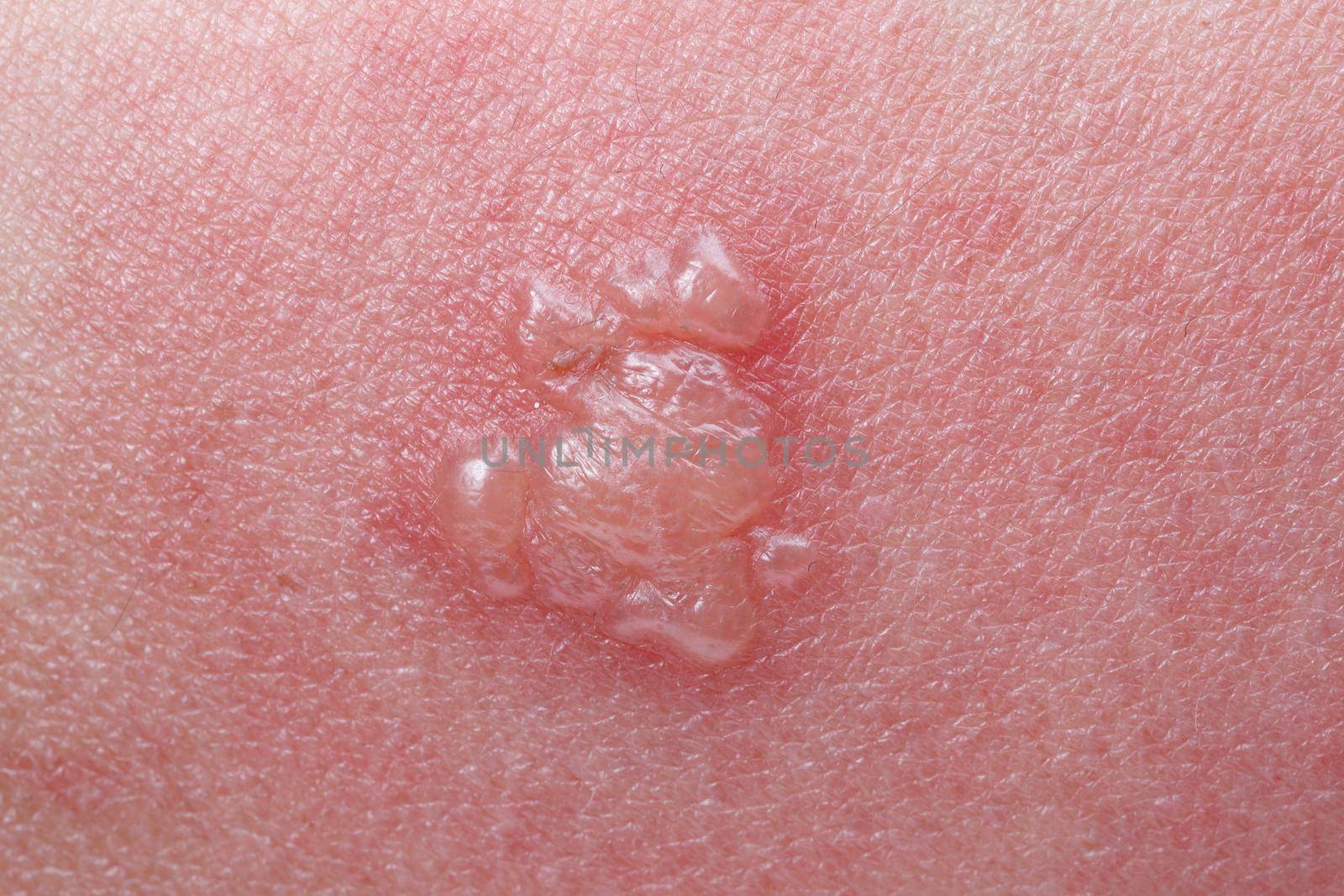 Shingles, Zoster or Herpes Zoster symptoms on arm by toa55