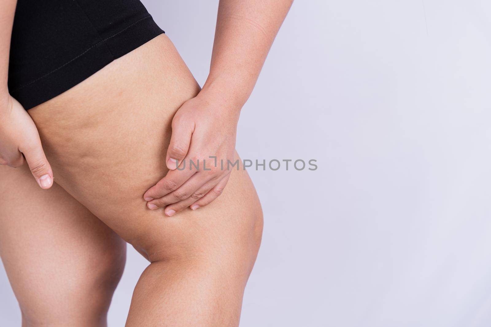 Female holding and pushing the skin of the legs cellulite or orange peel. Treatment and disposal of excess weight, the deposition of subcutaneous fat tissue by mikesaran