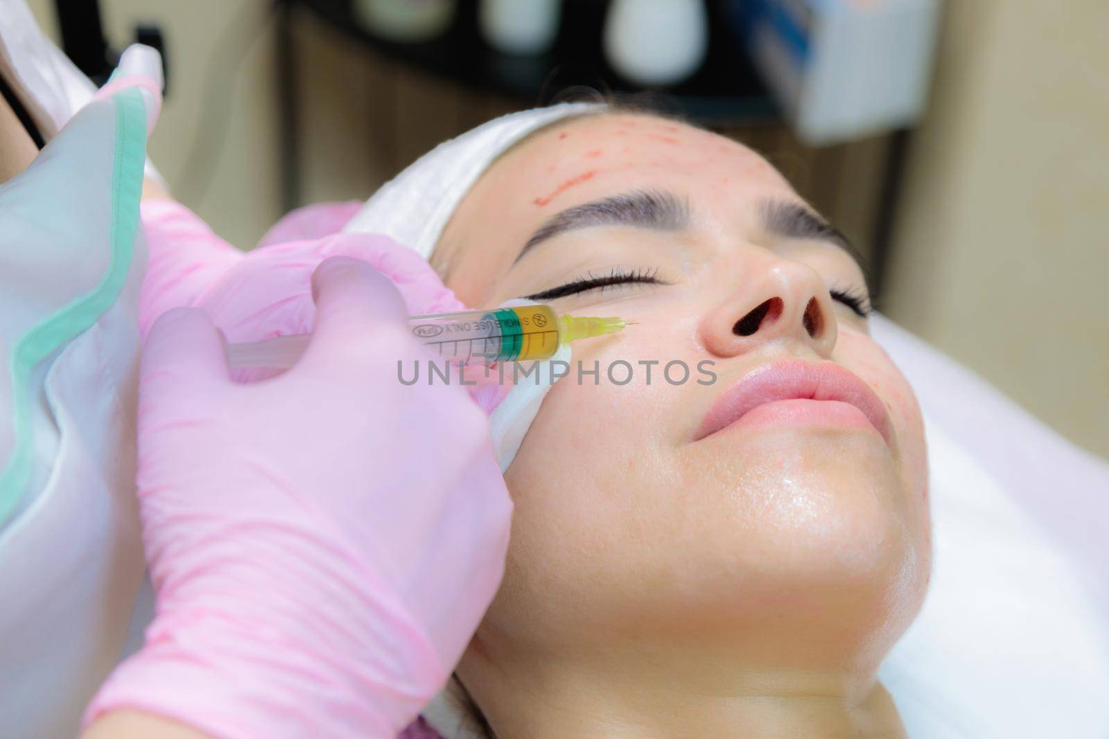 The doctor gives injections of blood plasma into the face of a young girl. Therapeutic procedure, plasmolifting