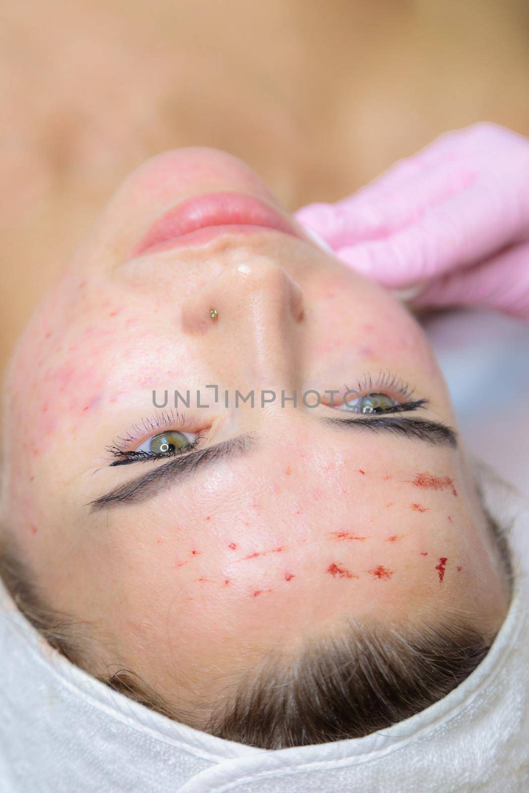 A young woman is wiped off traces of blood from a plasma injection on her face. Plasmolifting. Apply cream.