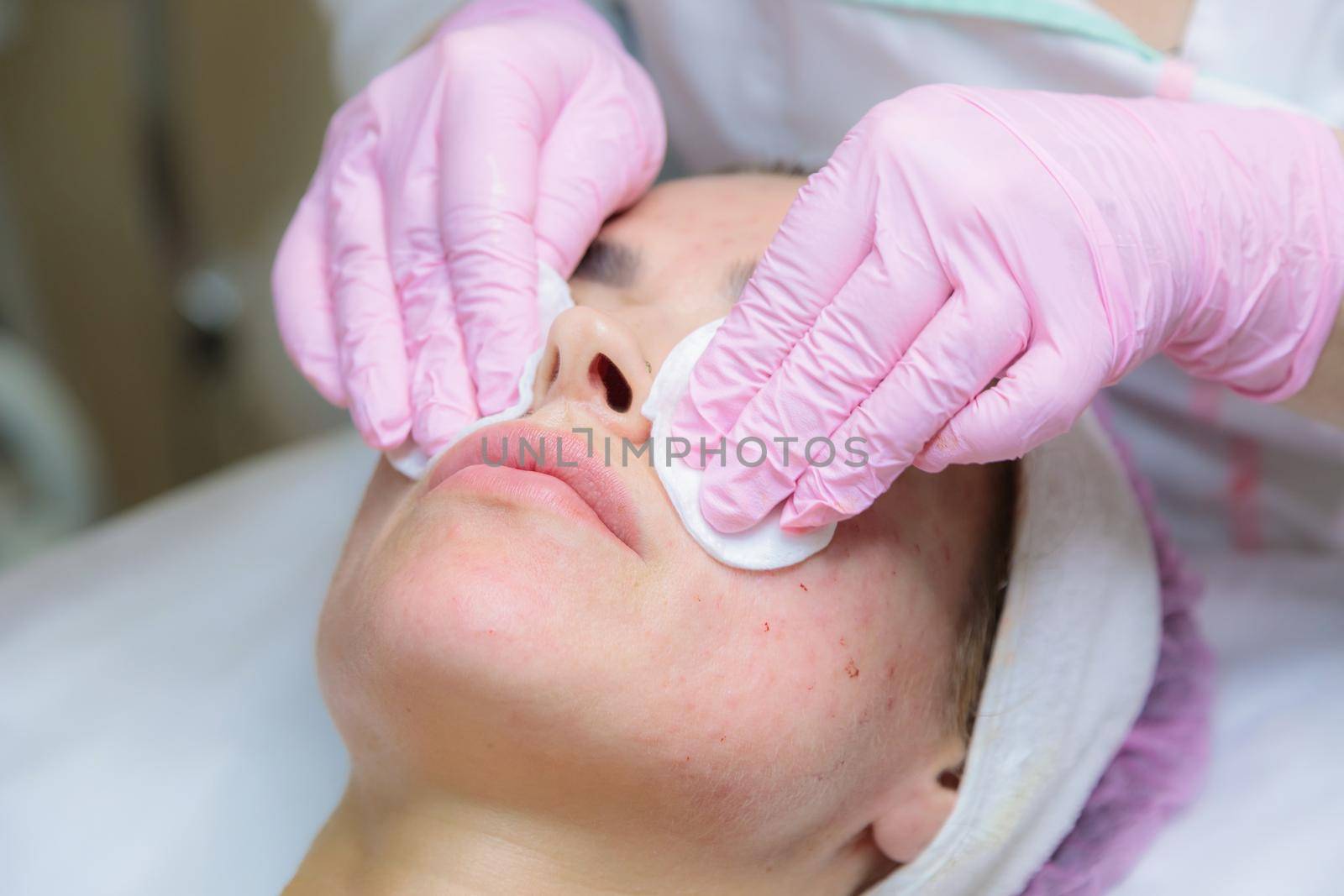 A young woman is wiped off traces of blood from a plasma injection on her face. Plasmolifting. Apply cream.