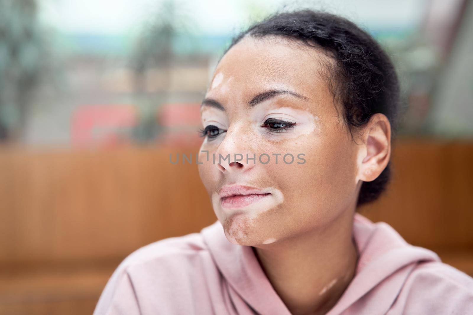 Black african american woman with vitiligo pigmentation skin problem indoor dressed pink hoodie close up portrait pensive black female thinking about