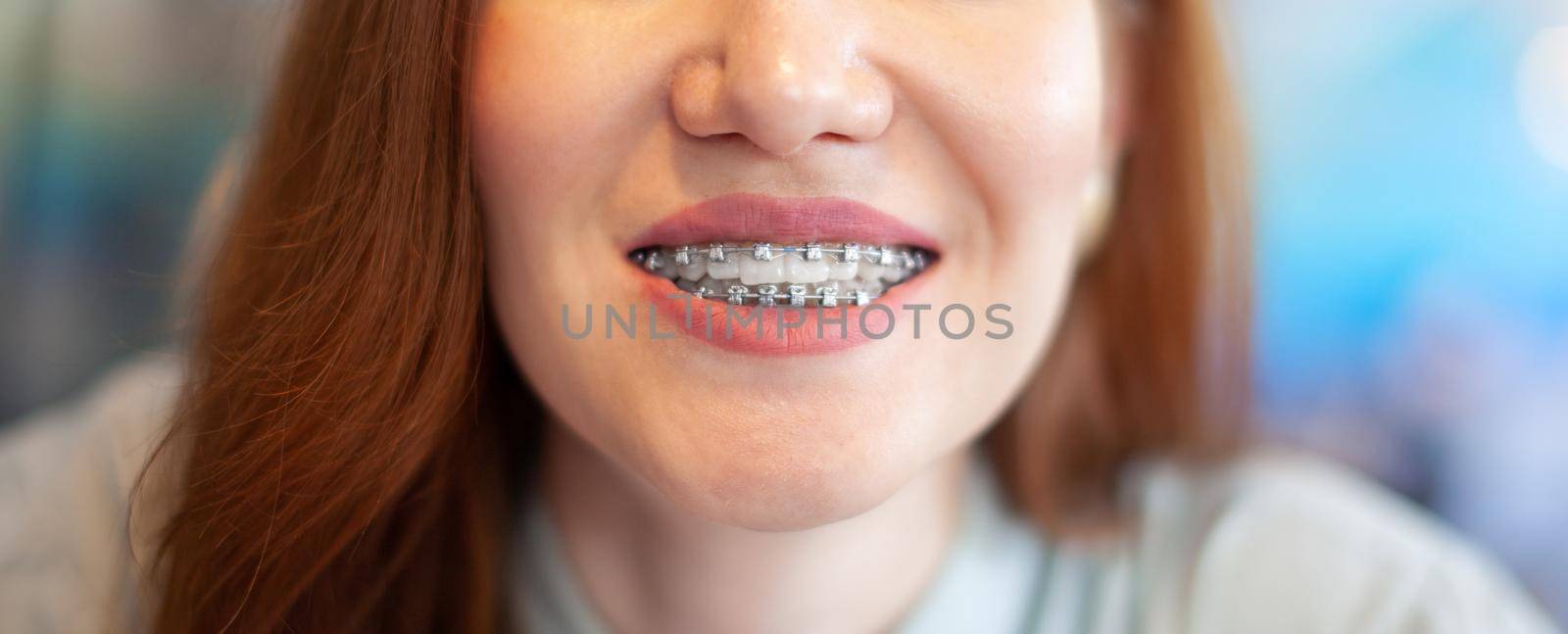 The smile of a young girl with braces on her white teeth.  by AnatoliiFoto