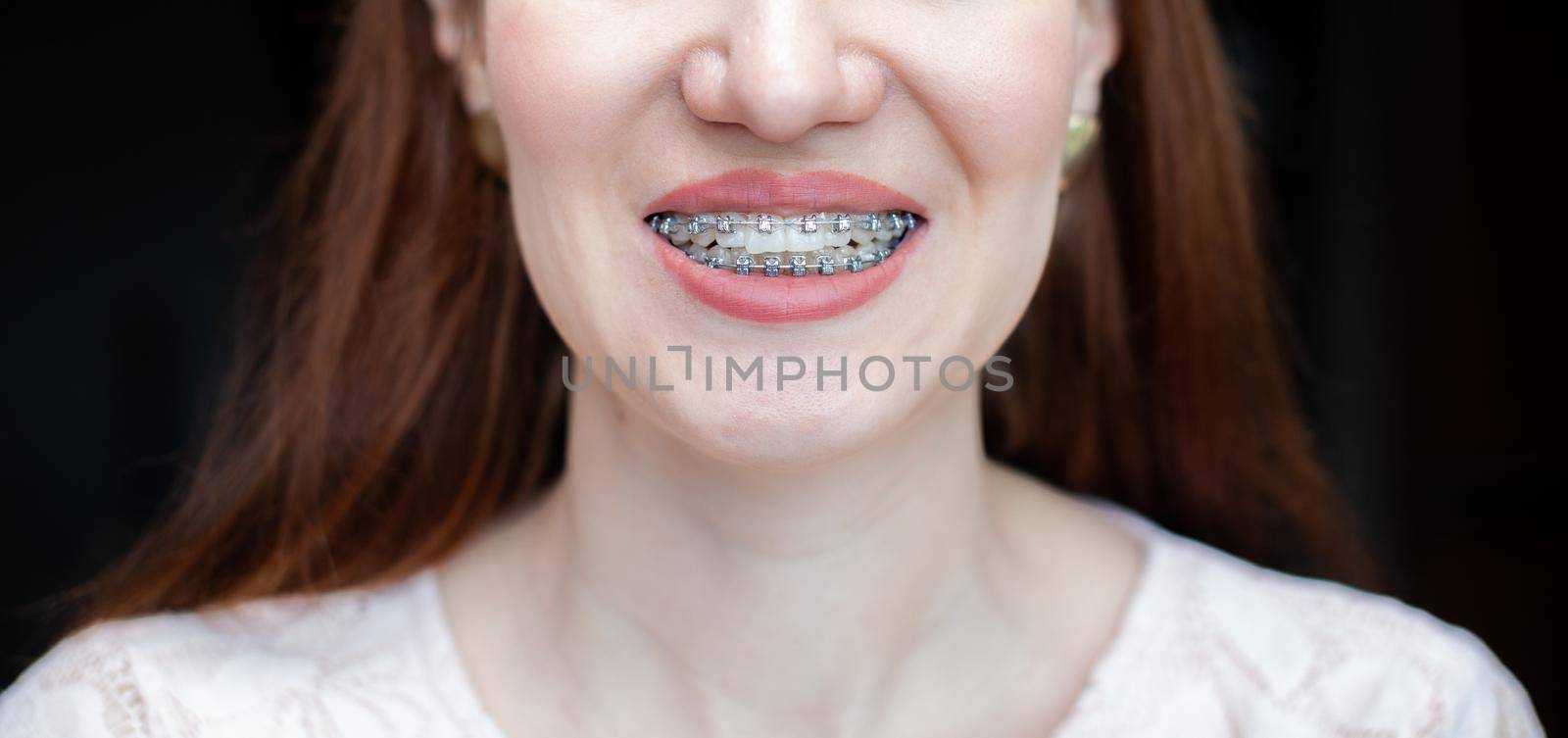 The smile of a young and beautiful girl with braces on her white teeth. Straightening of crooked teeth with the help of a bracket system. Malocclusion. Dental care. Smooth teeth and a beautiful smile