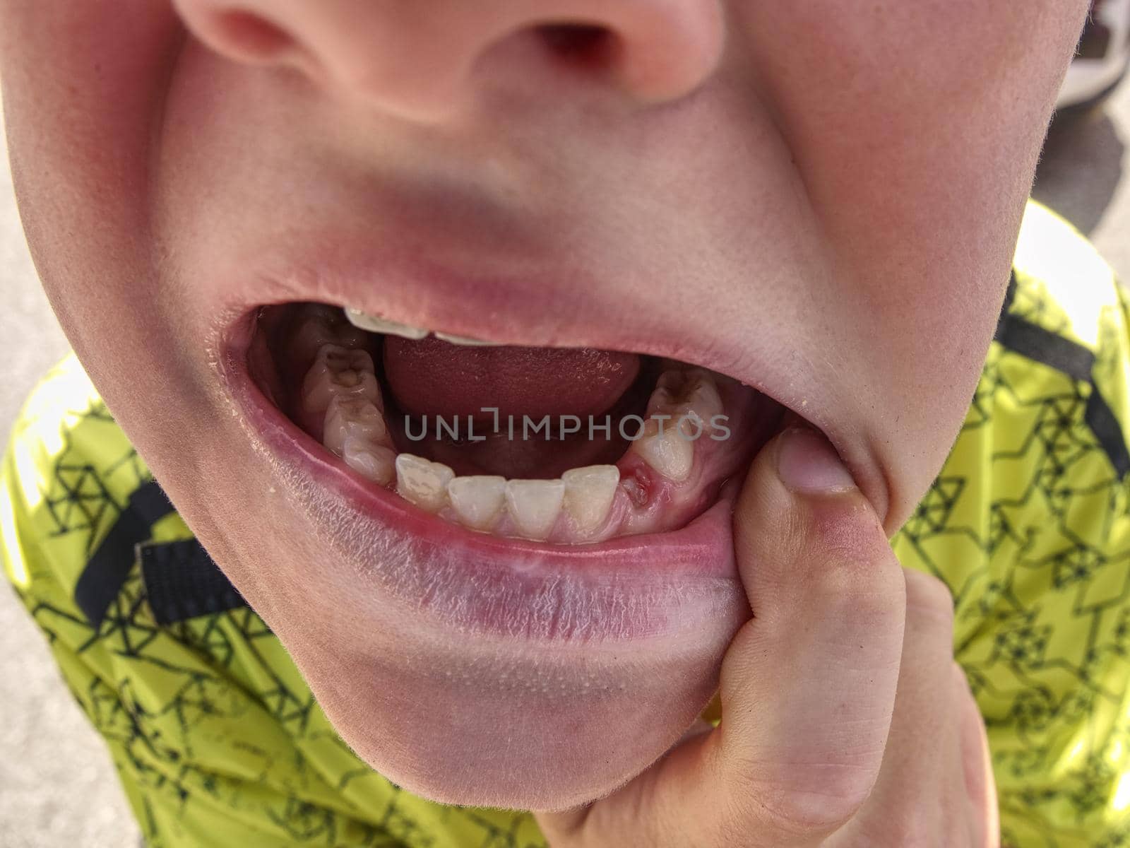 Child showing the first canine tooth pulled out. Boy mouth by rdonar2