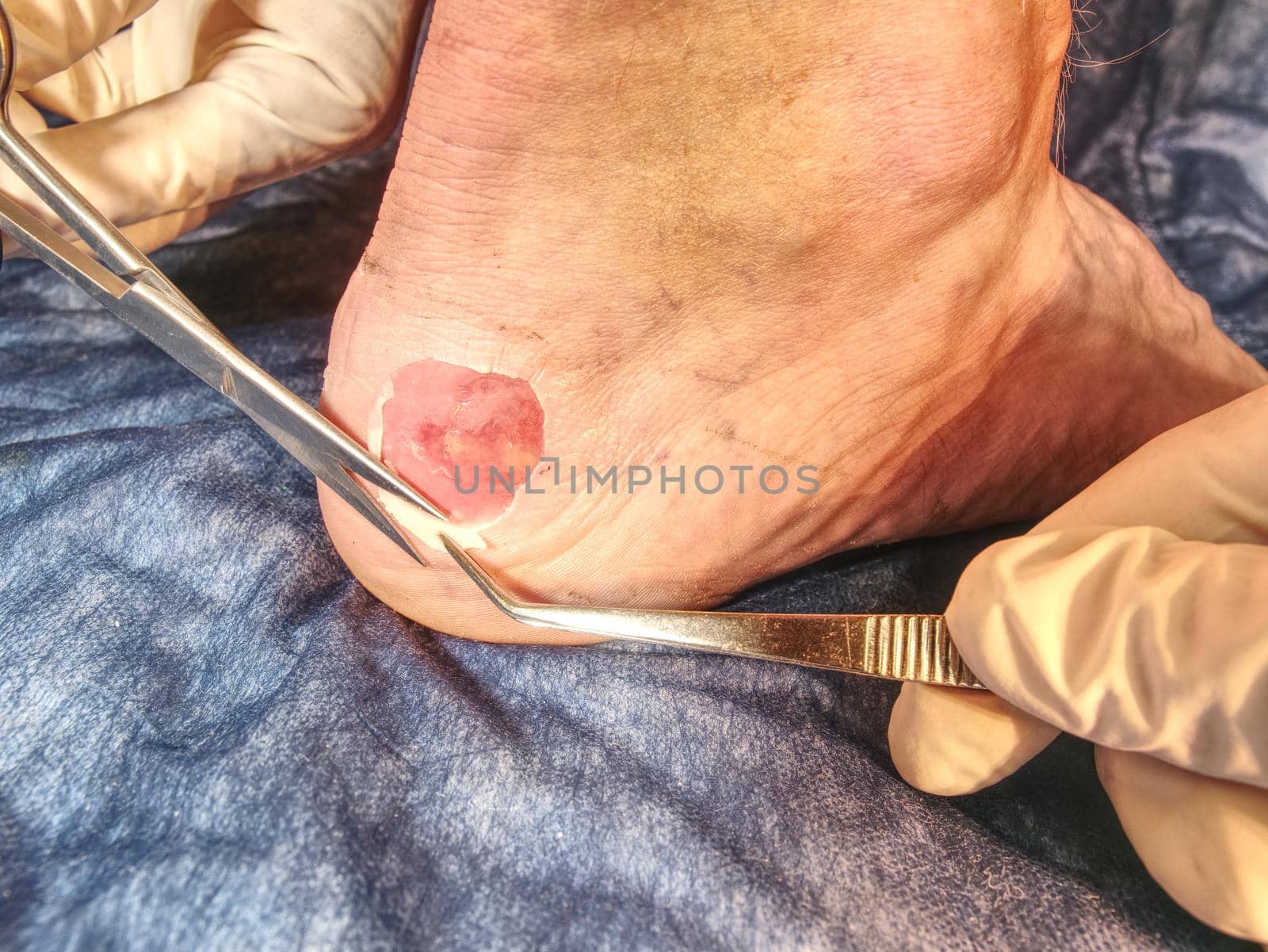 Hot painful place with bloody skin and wetted wound. Wet bloody abrasion on the skin beneath the ankle of a sports patient. 
