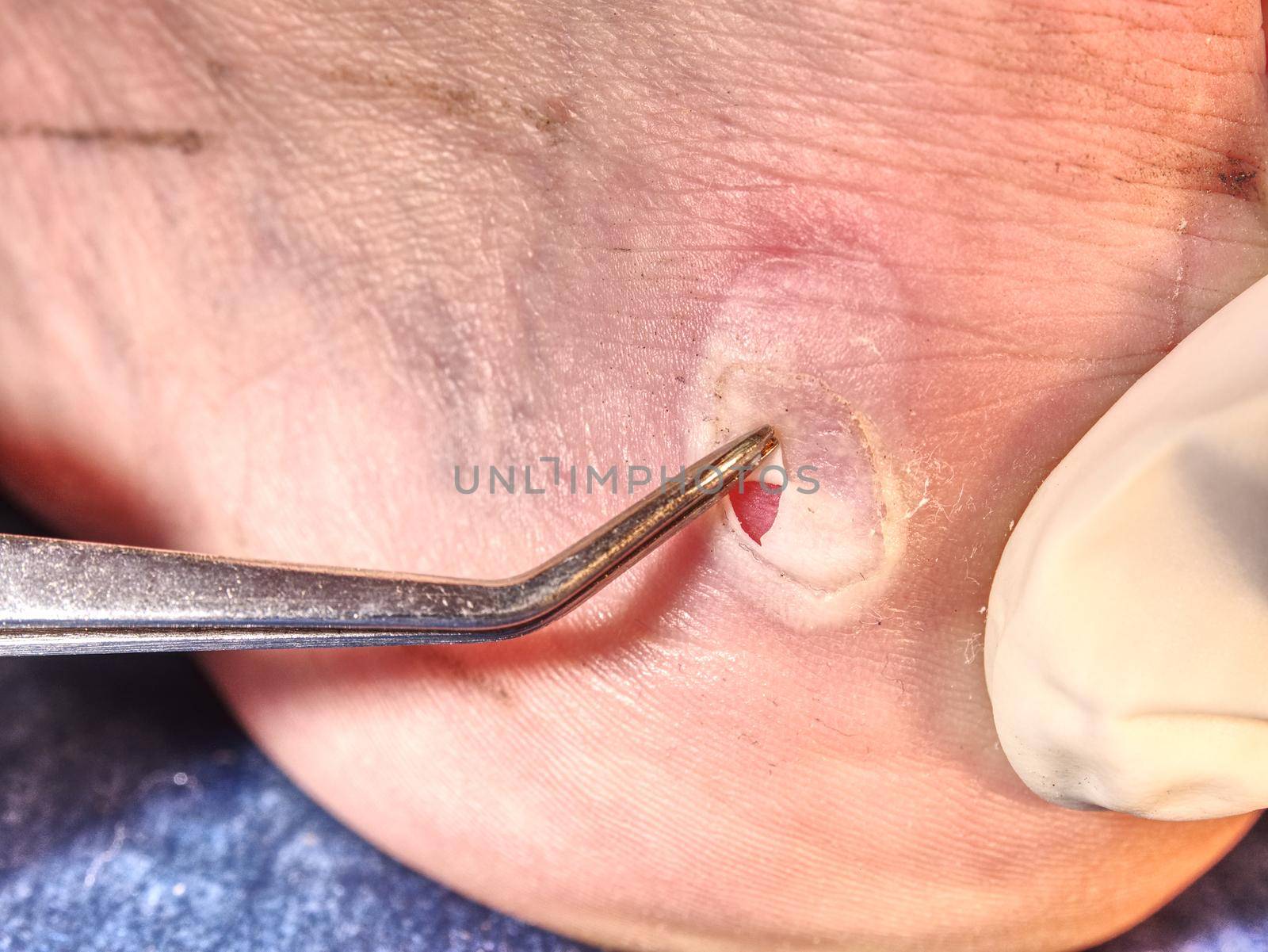 Small surgery on hurt leg, treatment of the wetting wound. Untouchable hot heel with burned skin. 