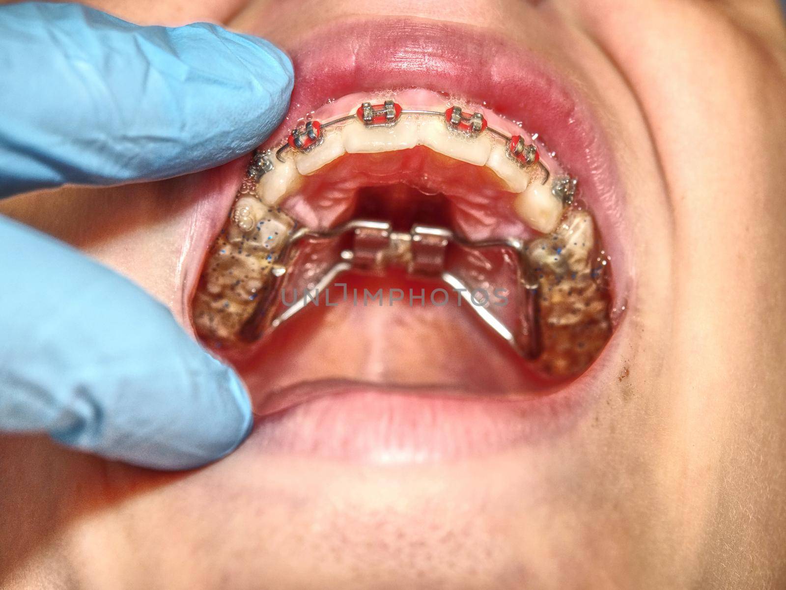 Patient with  dental braces during check or  treatment, dental mirror dentist tools side view. 