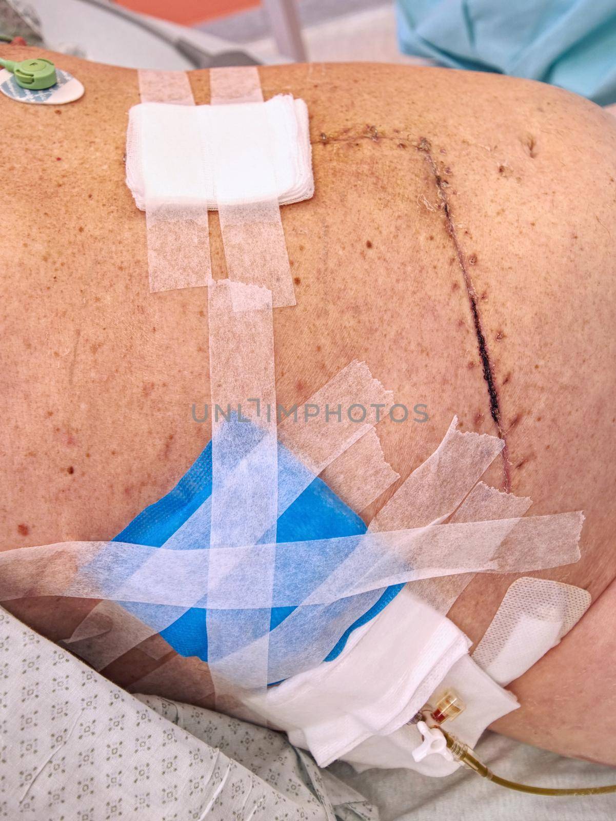 The patient shows a fresh, large scar after bowel and liver surgery and plastic tubing to remove lime and pus.