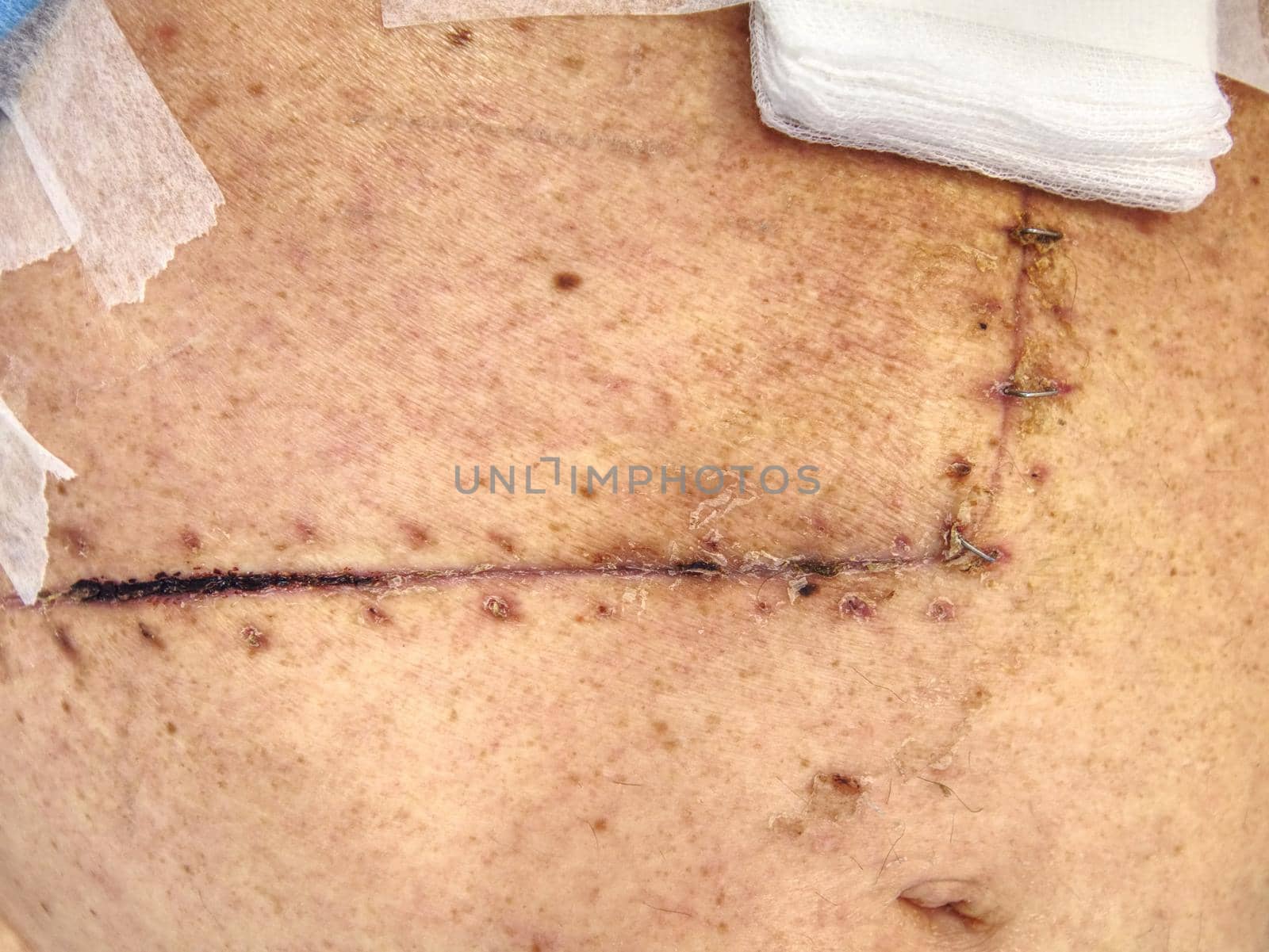 Man patient  with long abdominal scars after gallbladder and bowel surgery or operation 