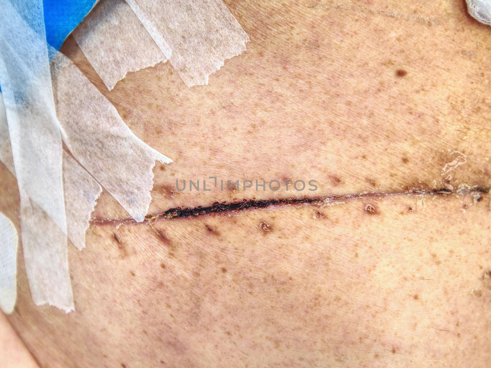 Father after cancer  liver and bowel cancer surgery. Bandage of fresh scar on the abdomen and side of male body.