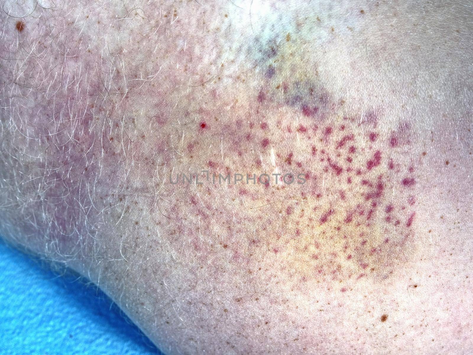 Large bruise on wounded man leg skin laying in bed. Colorful  by rdonar2