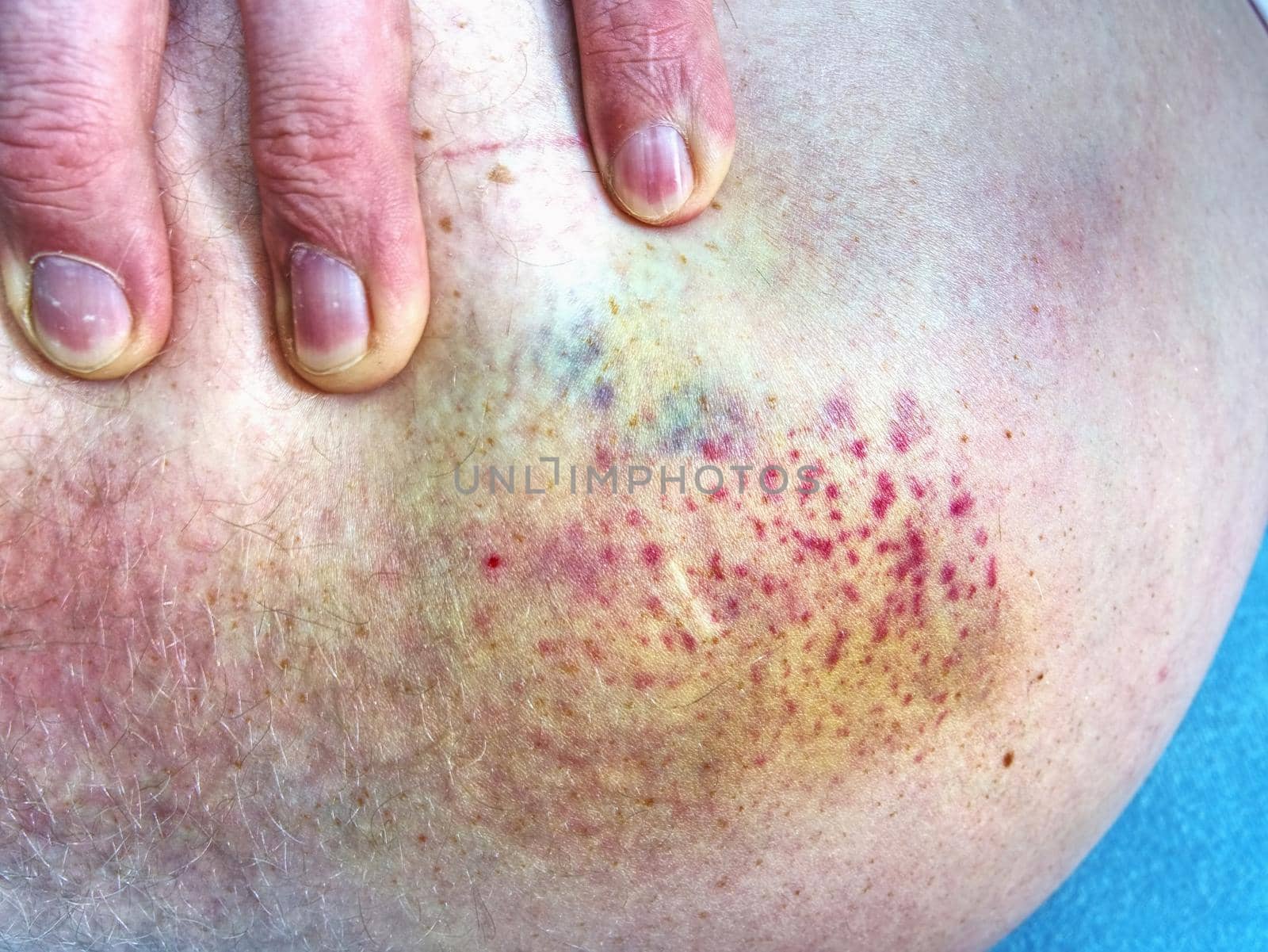 Bruised wound injury on human body. Patient show injured body with large paintful hematoma. 