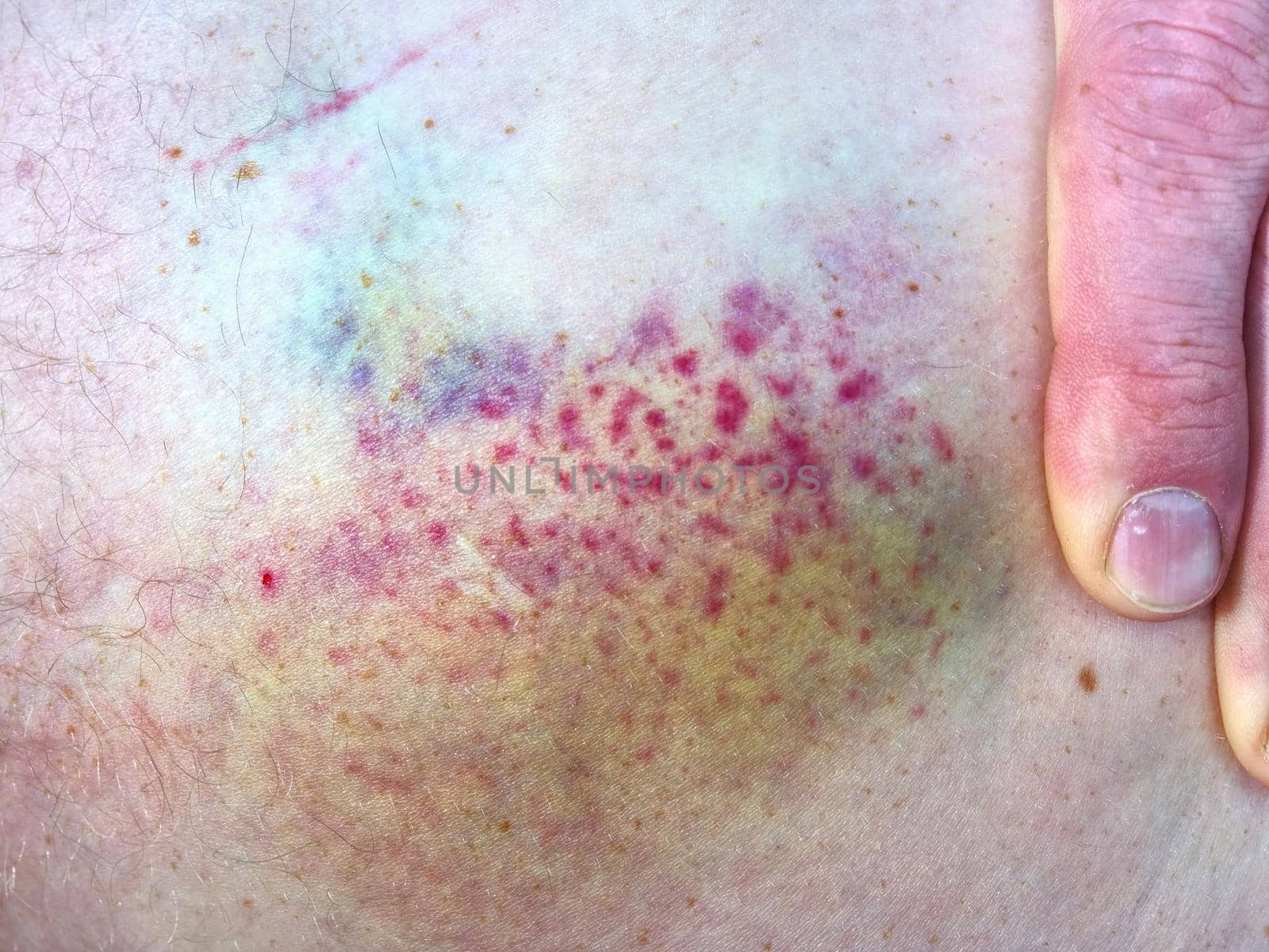 Fresh bruise on white skin.  Painful green purple huge  bruise on leg.  by rdonar2