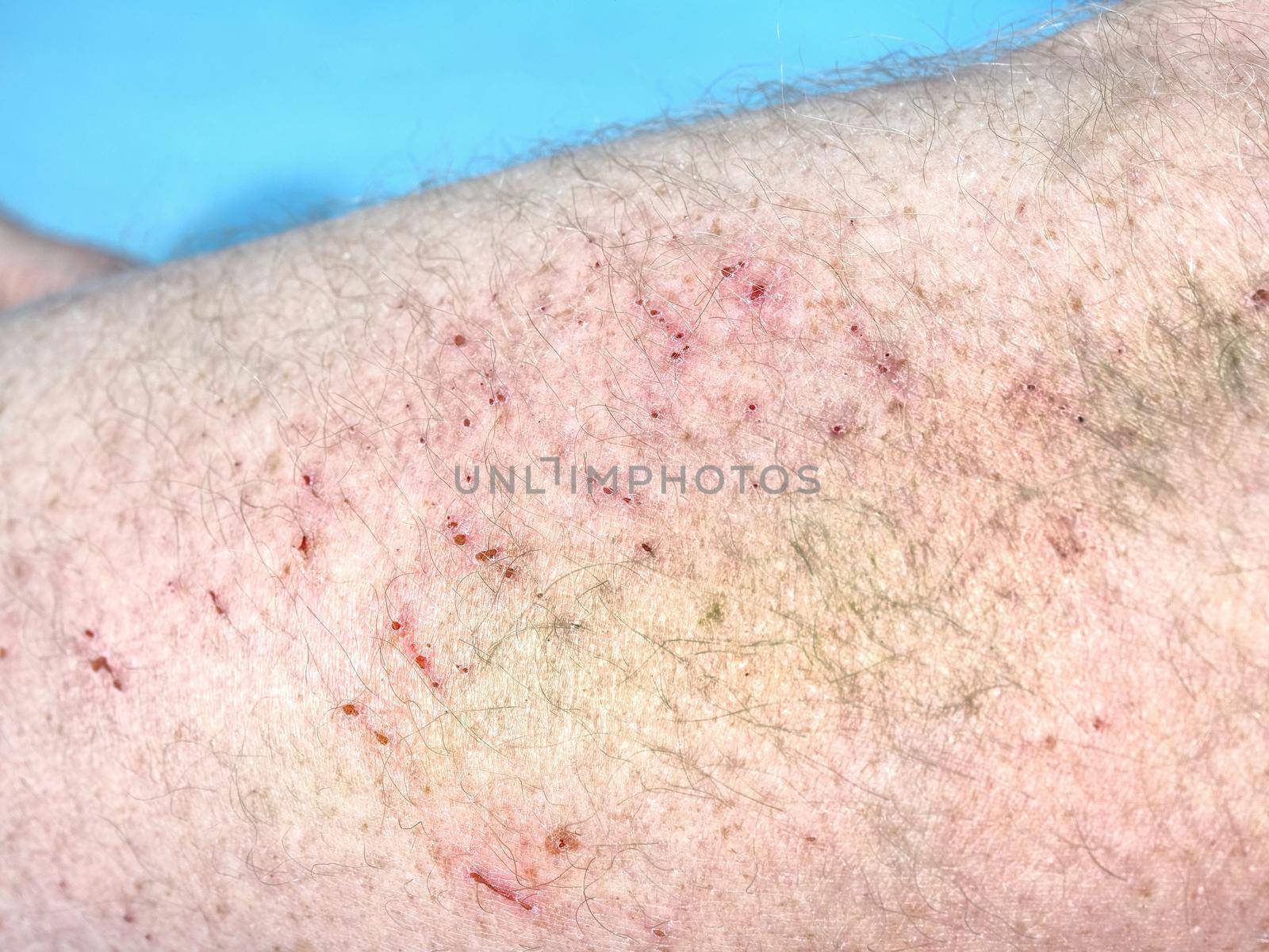 Detail of hematoma, cracked veins just below the surface of the skin. Painful incident.
