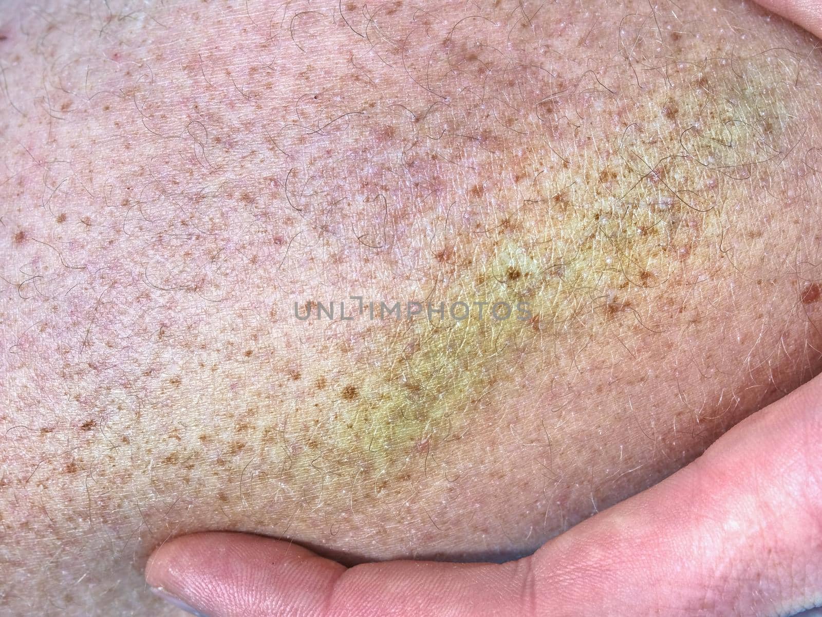 Large colorful bruise on human body. Painful hurt place after sporty incident. Detail of male body. Painful subcutaneous injury on human skin