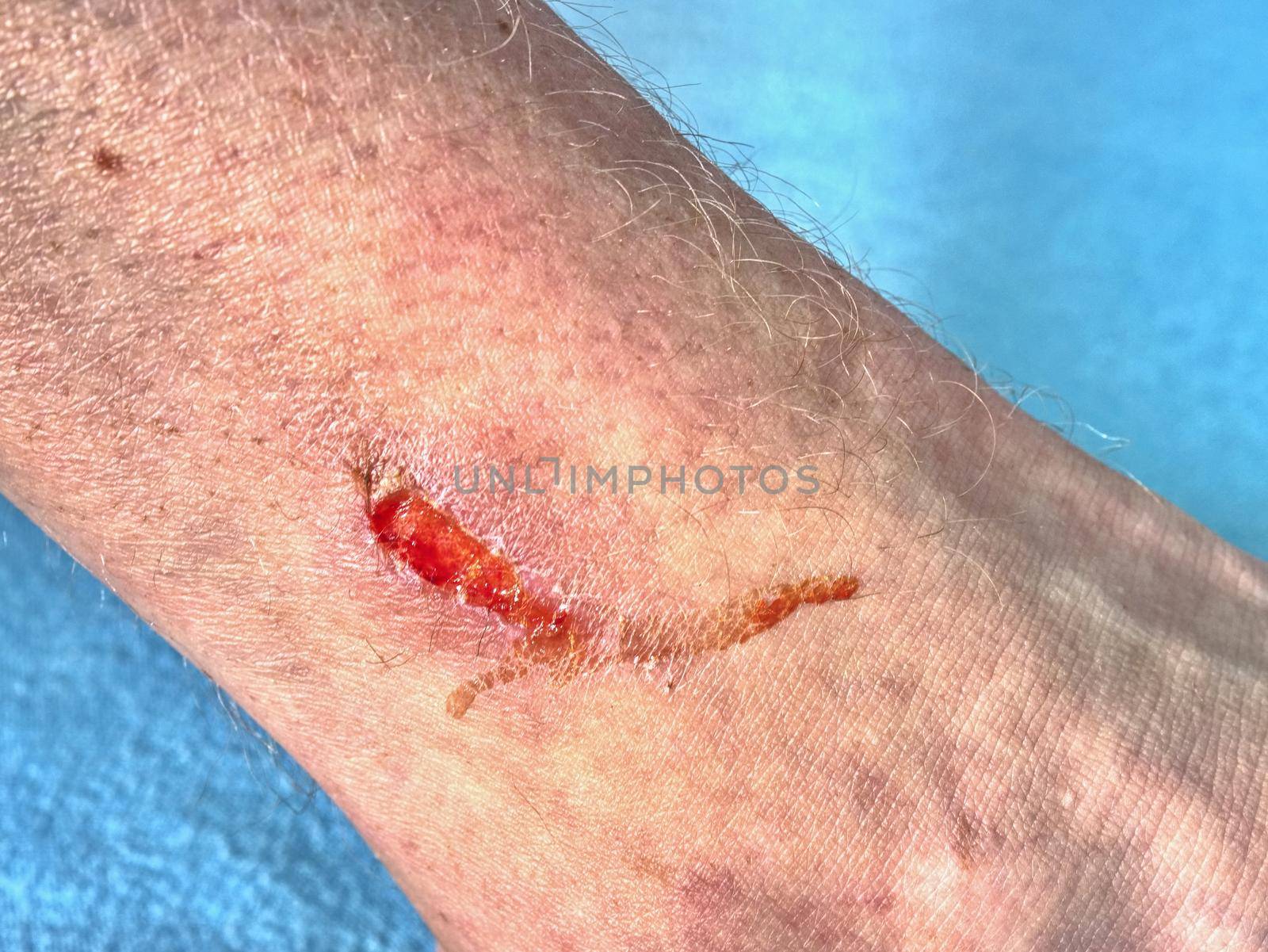 Skin wound. Wet Abrasion. Deep wound on the skin in detail. 