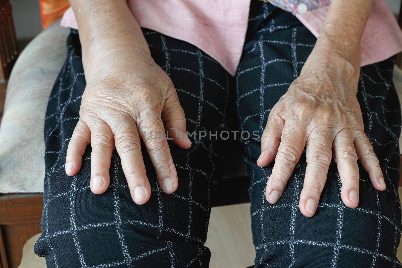 Elderly swollen hand or edema hand