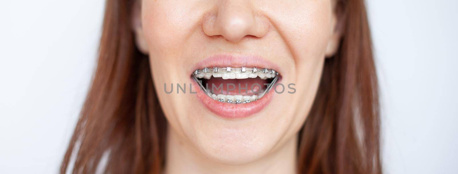 The woman smiles, showing her white and even teeth with braces. by AnatoliiFoto