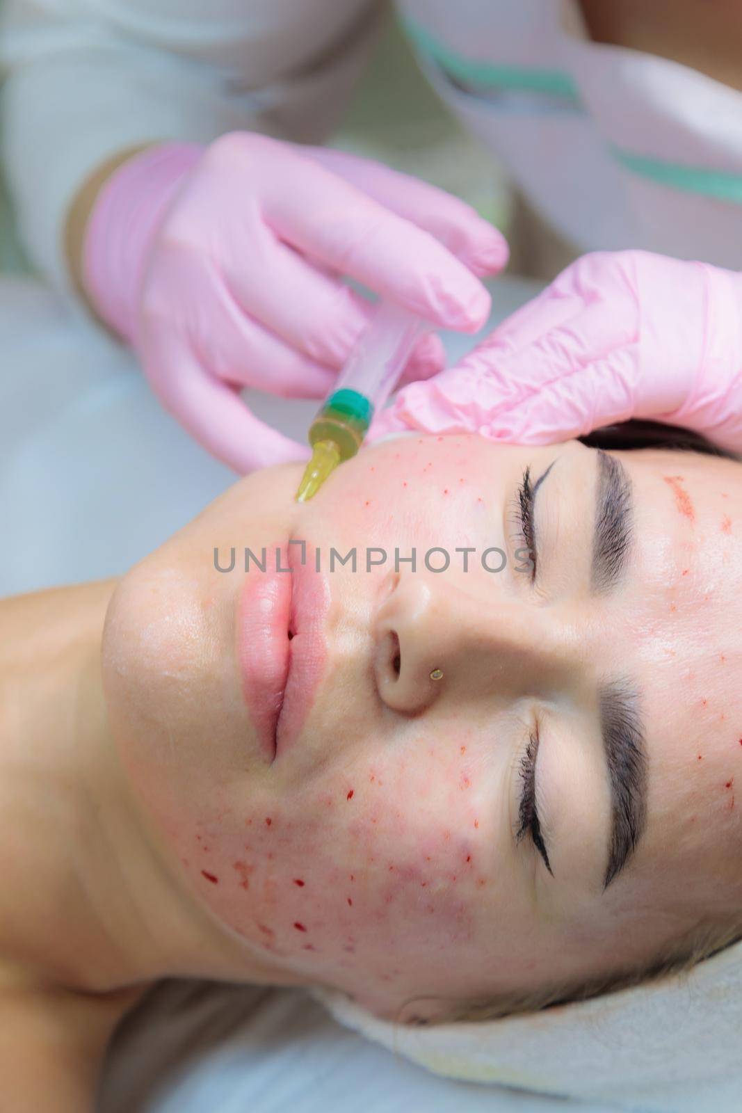 The doctor gives injections of blood plasma into the face of a young girl. Therapeutic procedure, plasmolifting