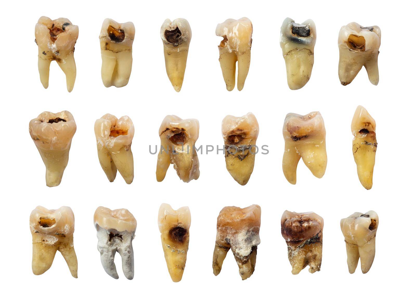 Set of teeth with dental caries ( tooth decay ) , fluorosis and calculus . isolated background . by stockdevil