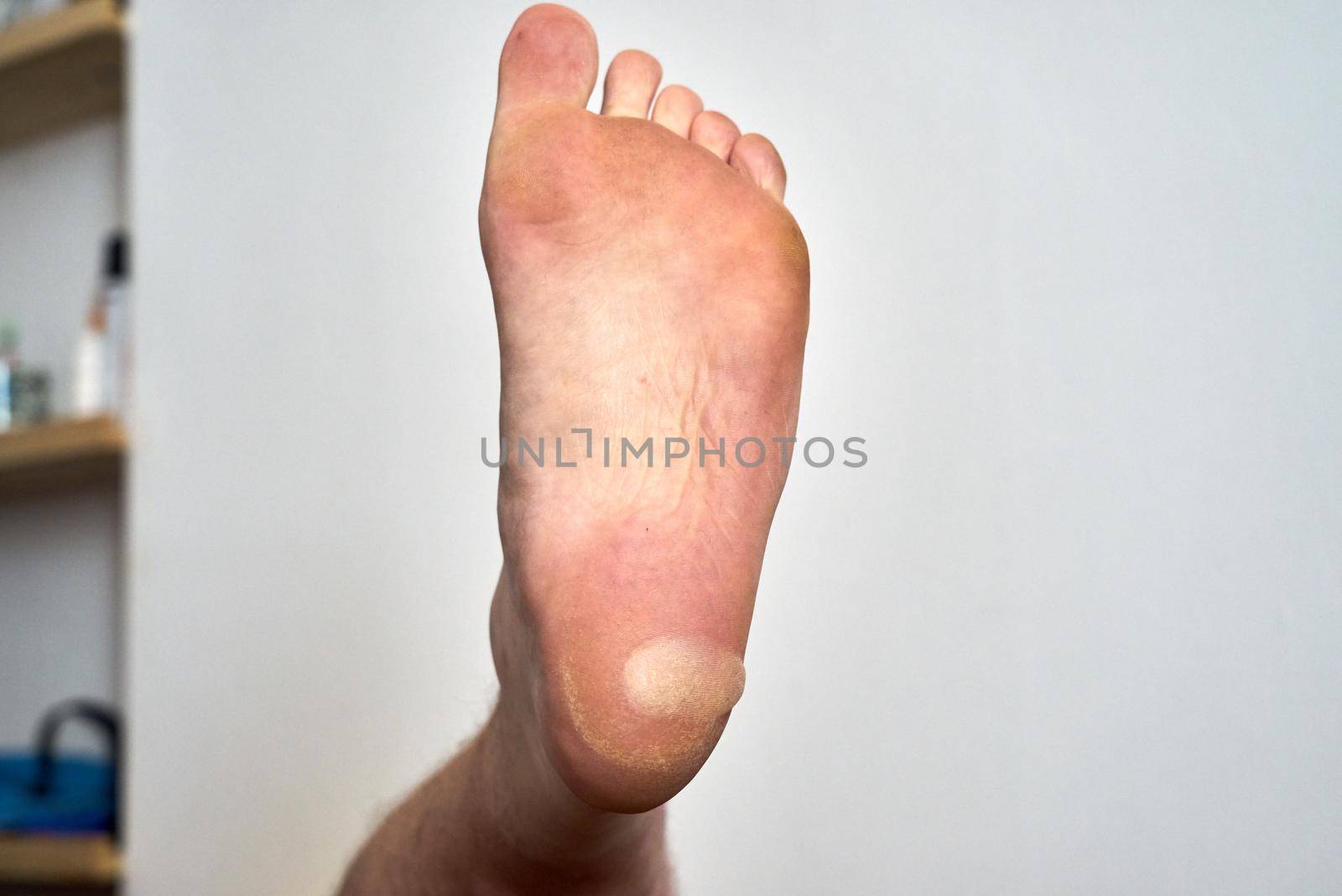 A large blister has formed on the heel of a foot due to rubbing in a shoe.