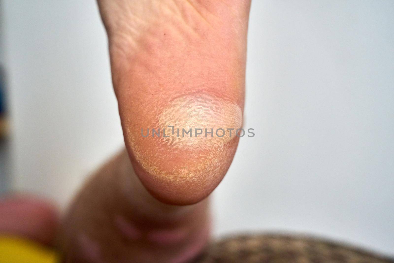 A large blister has formed on the heel of a foot due to rubbing in a shoe.