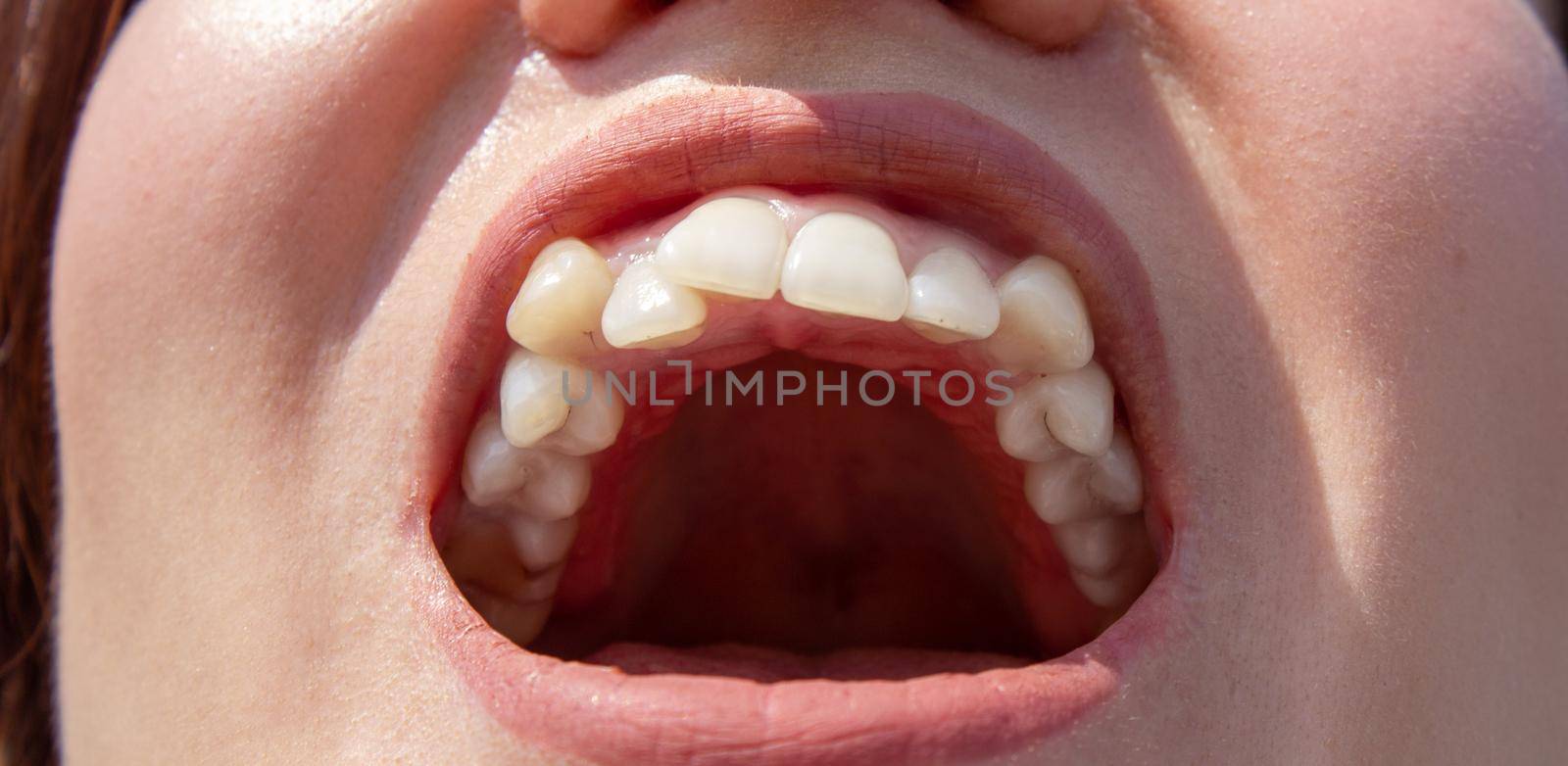 Curved female teeth, before installing braces. Close - up of teeth before treatment by an orthodontist