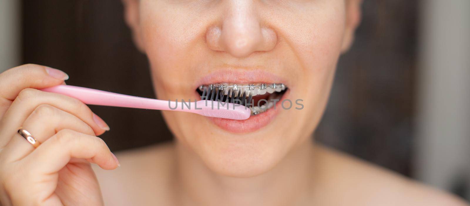 Girl with braces on her teeth brushing her teeth with a toothbrush, close-up. Dental and oral care. Braces for leveling teeth