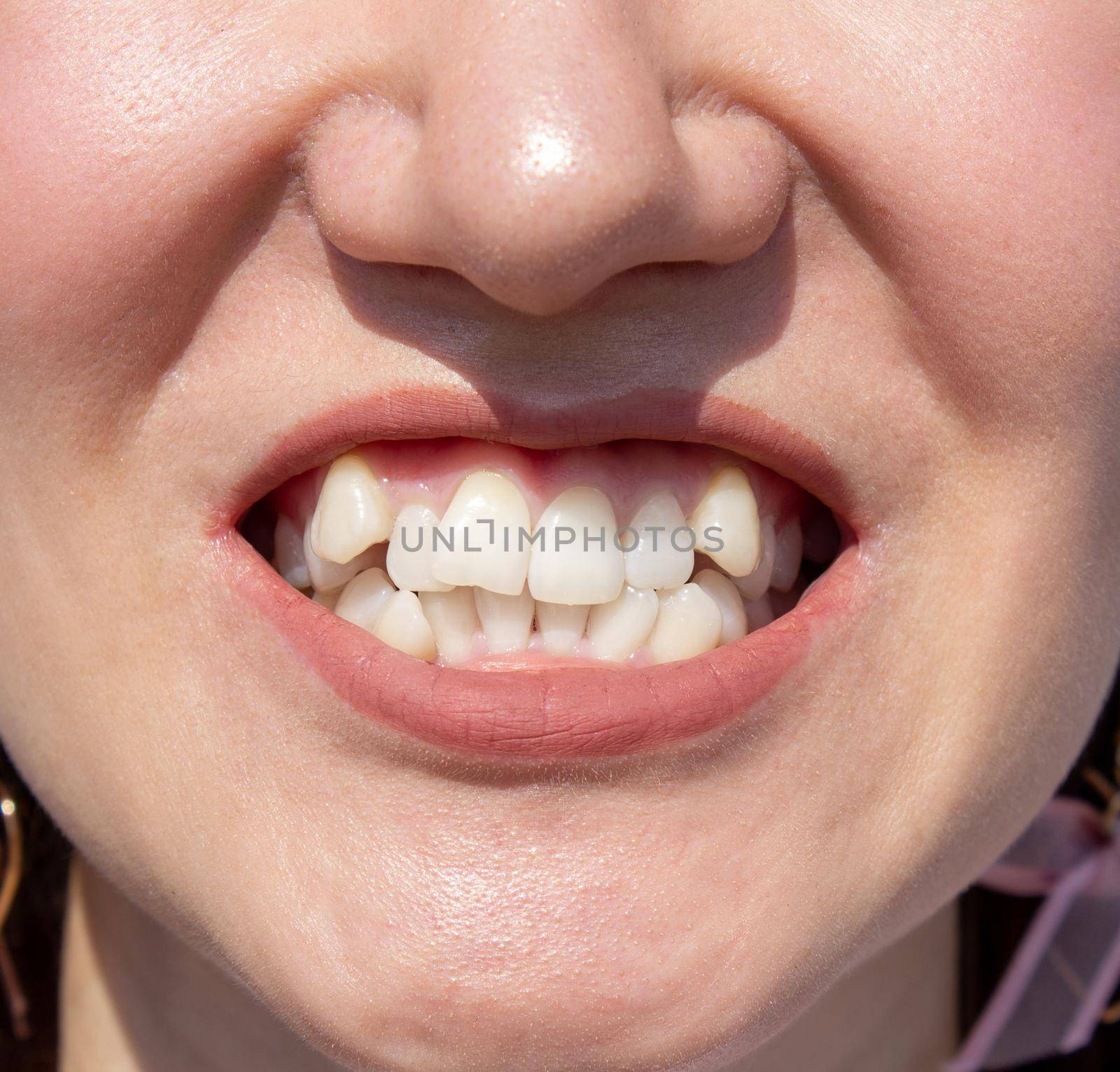 Curved female teeth, before installing braces Close - up by AnatoliiFoto