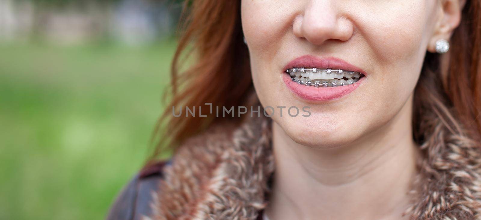 The smile of a young girl with braces on her white teeth. Teeth straightening. by AnatoliiFoto