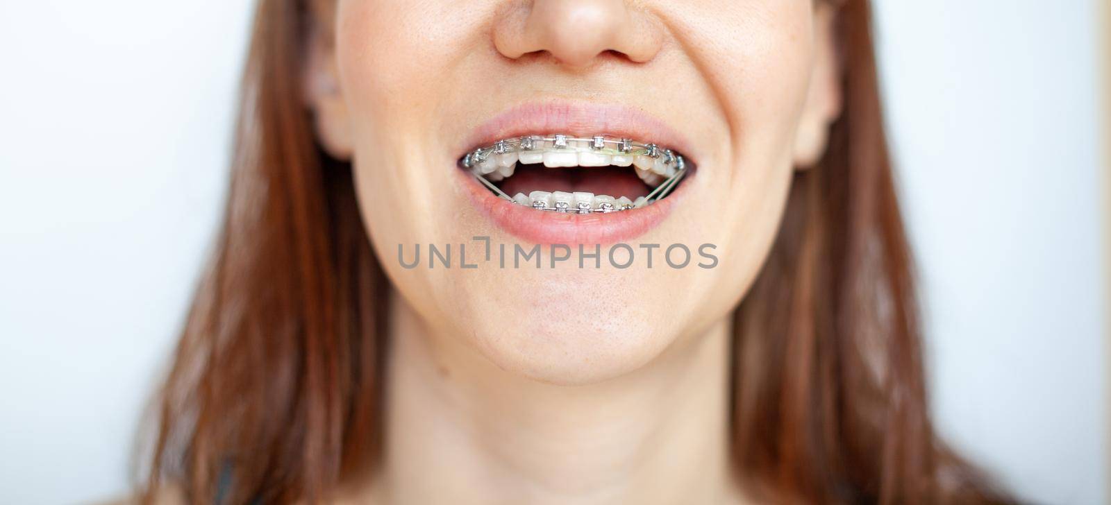 The woman smiles, showing her white teeth with braces. Even teeth from wearing braces. The concept of a dentist and an orthodontist.