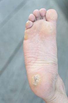 foot warts, corn