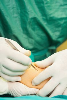 Close up of a surgeon holding a scalpel in a surgical room